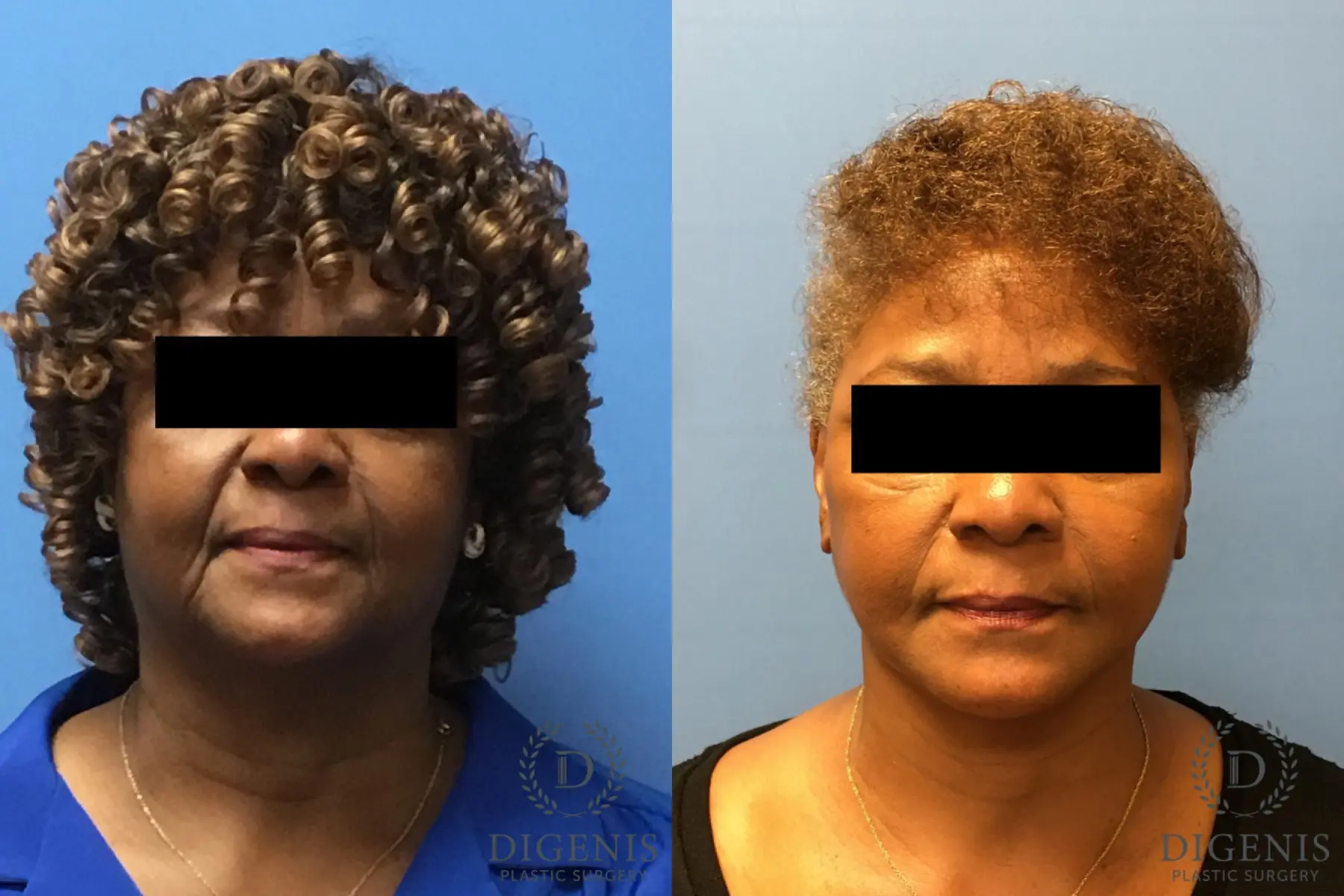 Facelift: Patient 9 - Before and After  