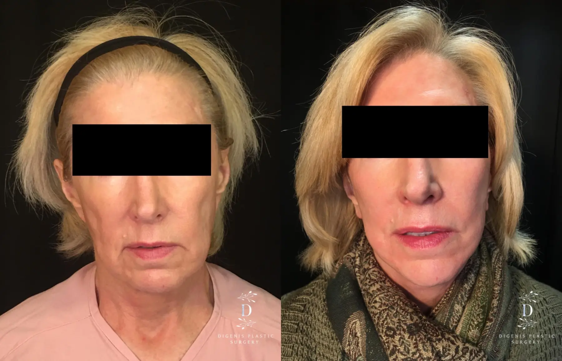 Facelift: Patient 21 - Before and After  