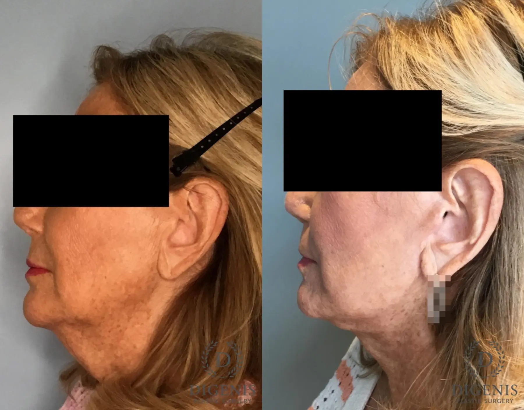 Facelift: Patient 69 - Before and After 5