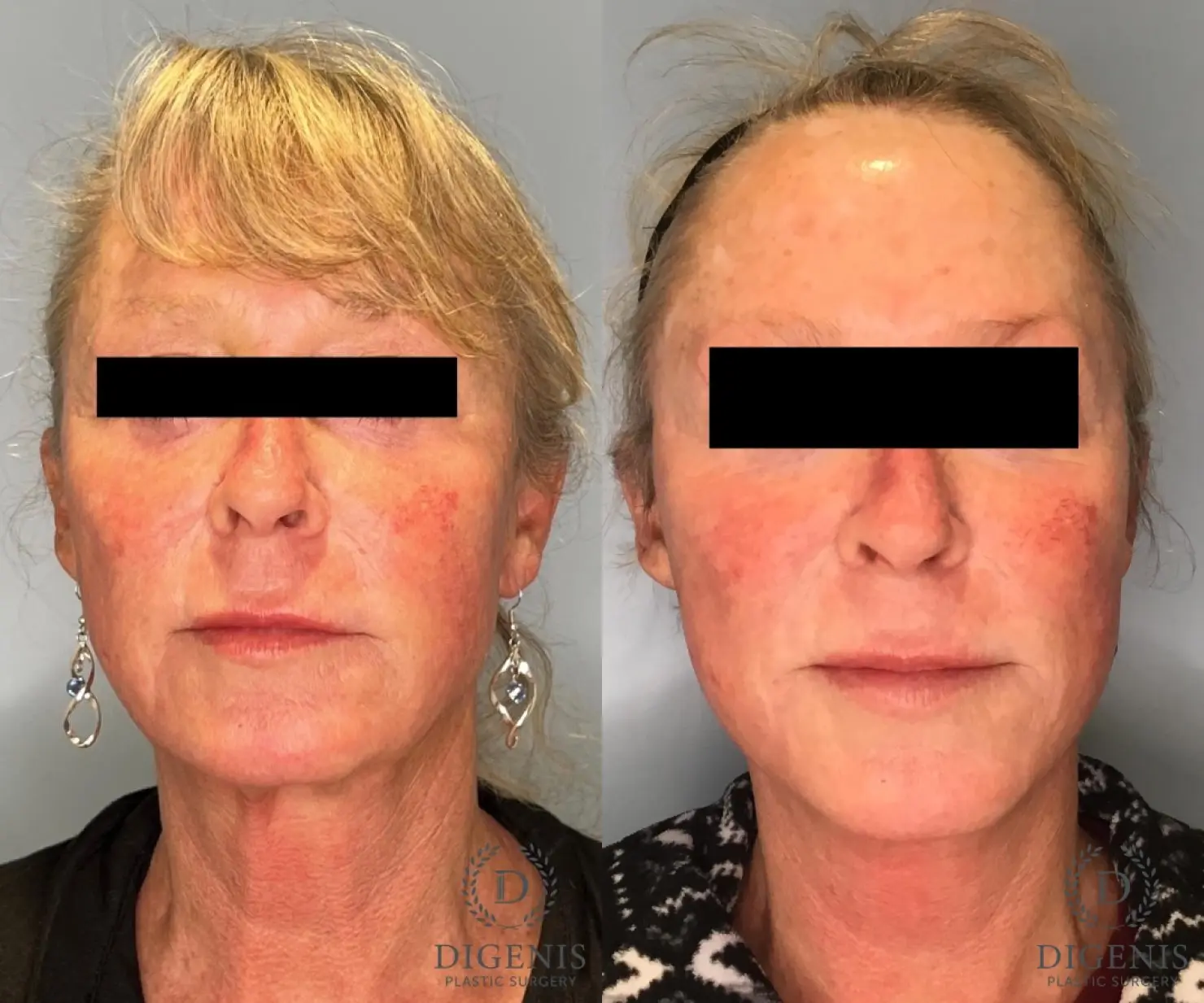 Facelift: Patient 17 - Before and After  