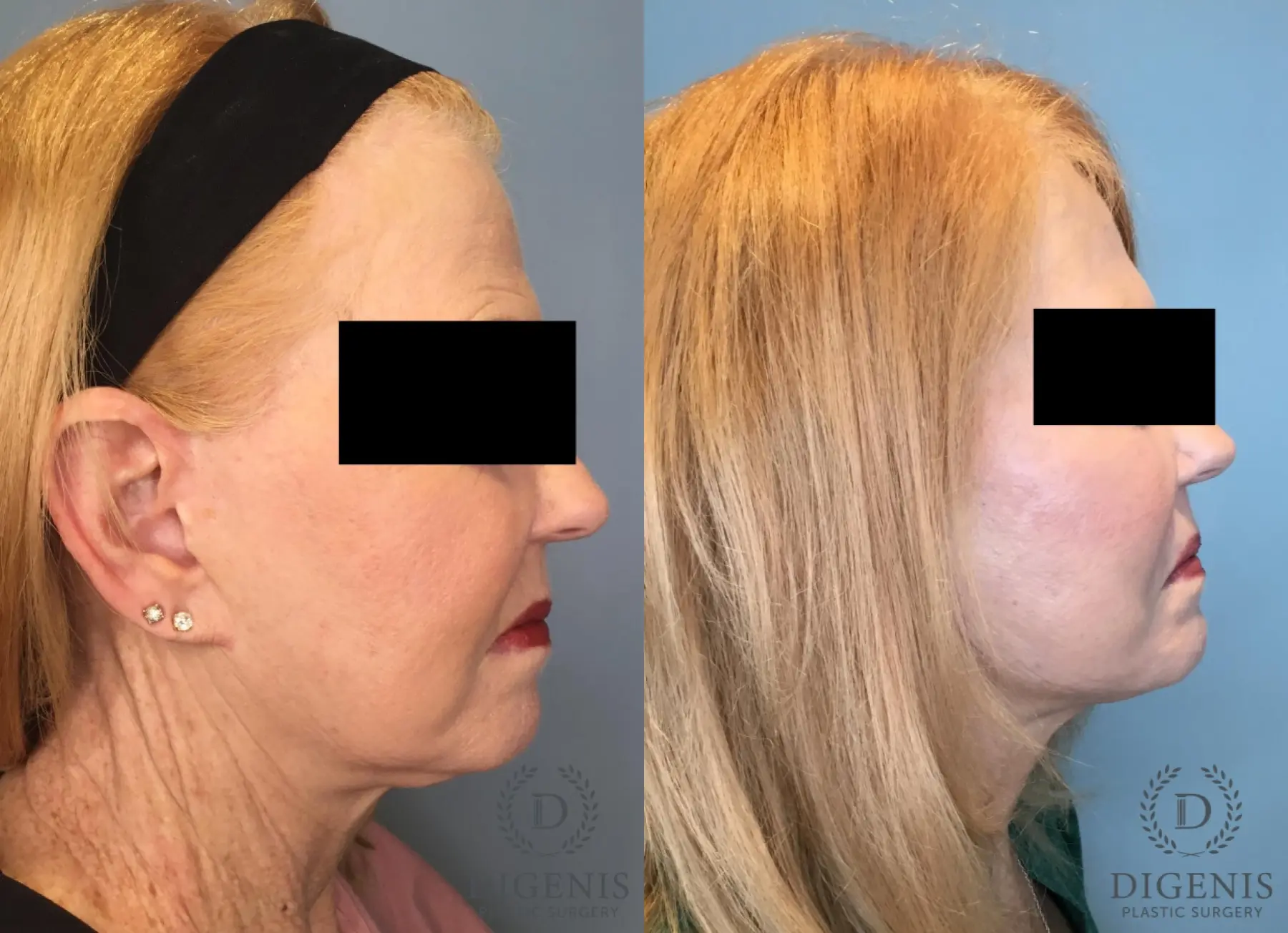Facelift: Patient 67 - Before and After 5