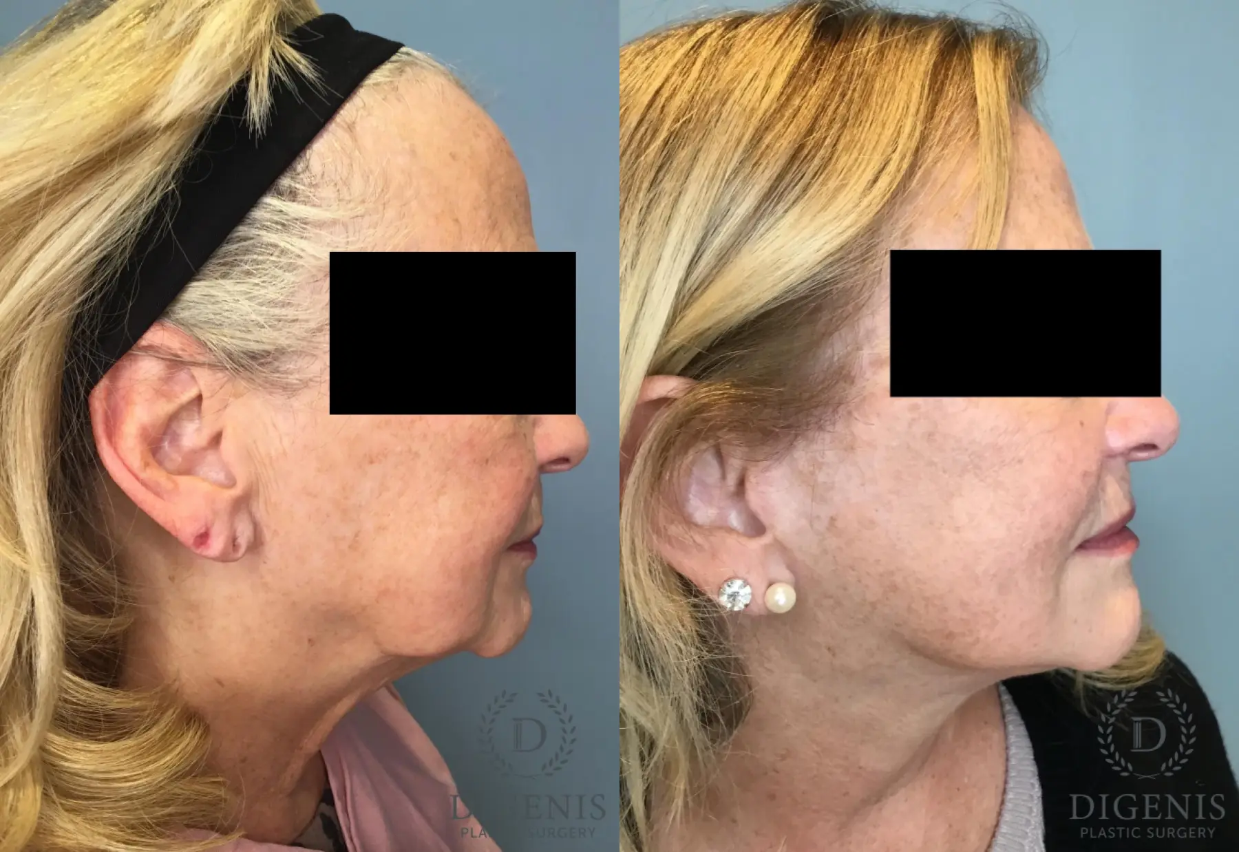 Facelift: Patient 73 - Before and After 5