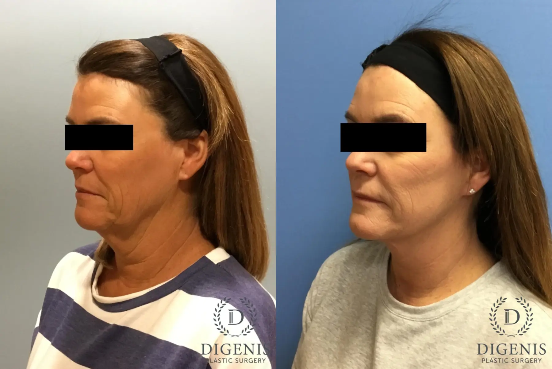 Facelift: Patient 12 - Before and After 4