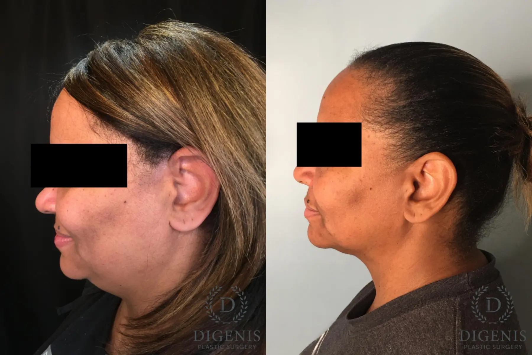 Facelift: Patient 63 - Before and After 5