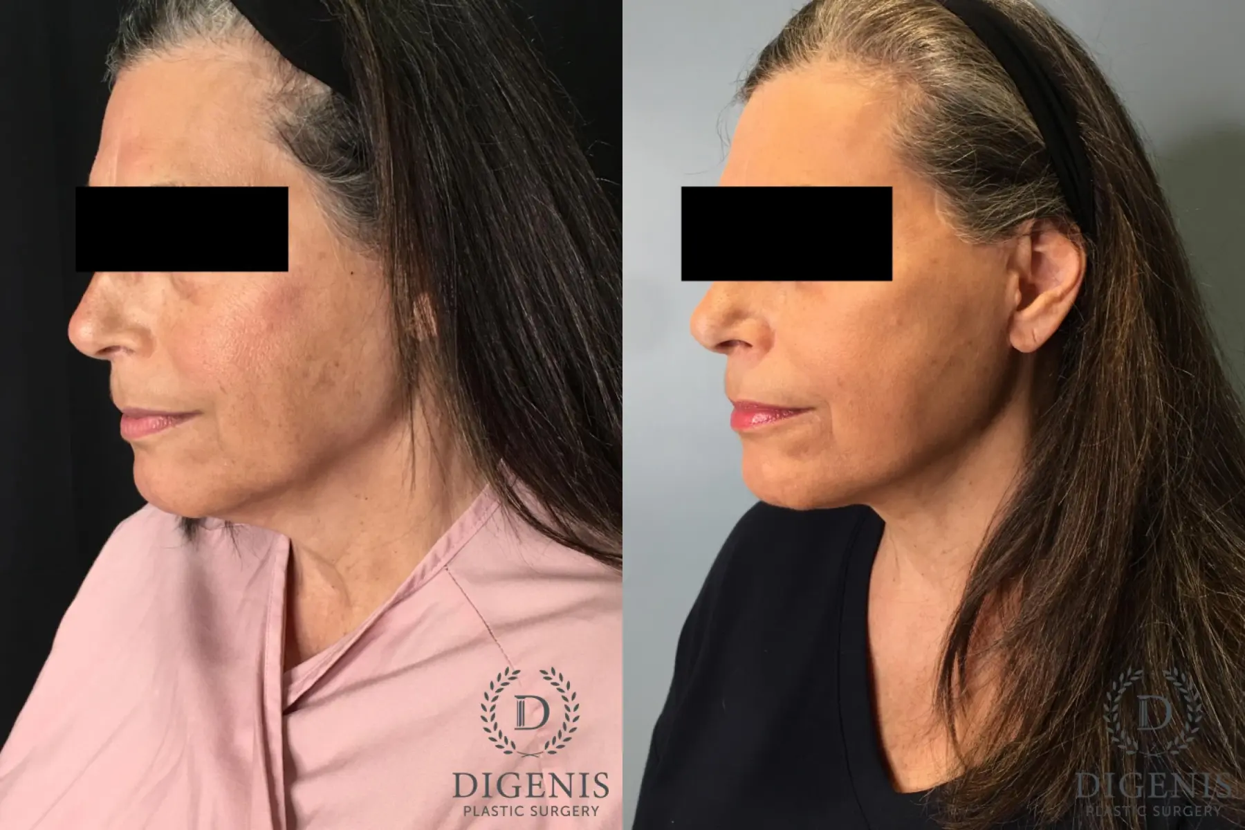 Facelift: Patient 26 - Before and After 4