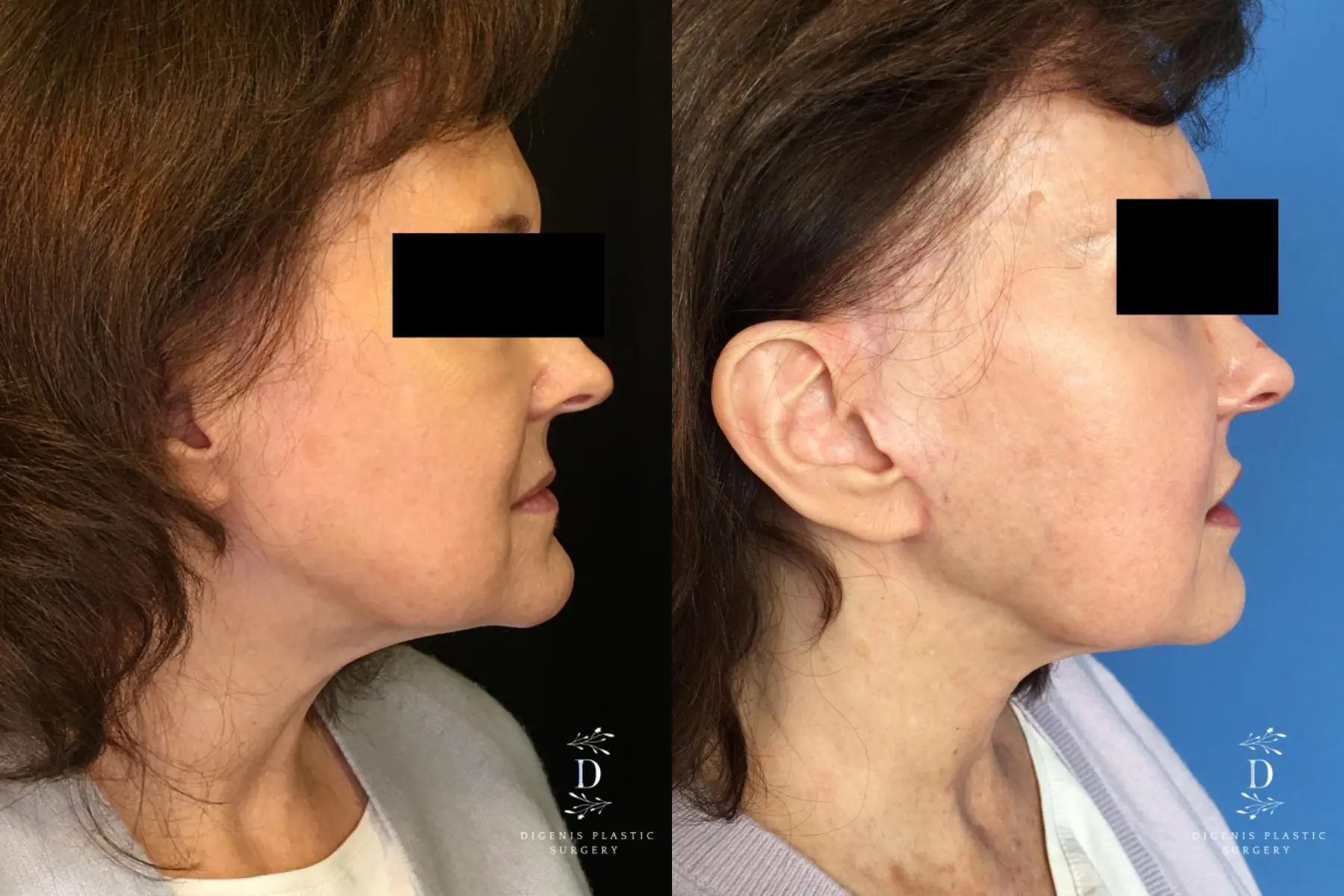 Facelift: Patient 17 - Before and After 2