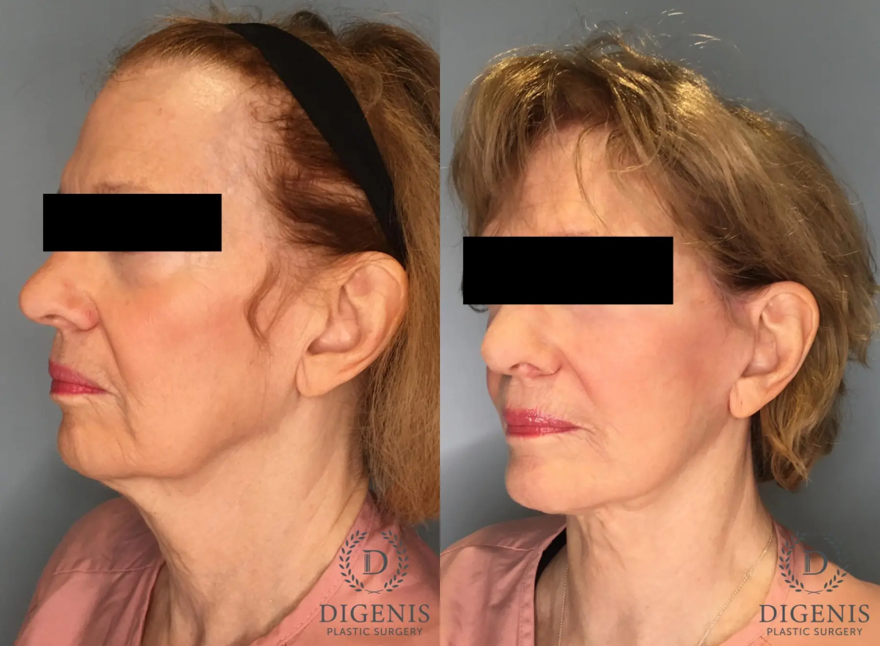 Facelift: Patient 21 - Before and After 4