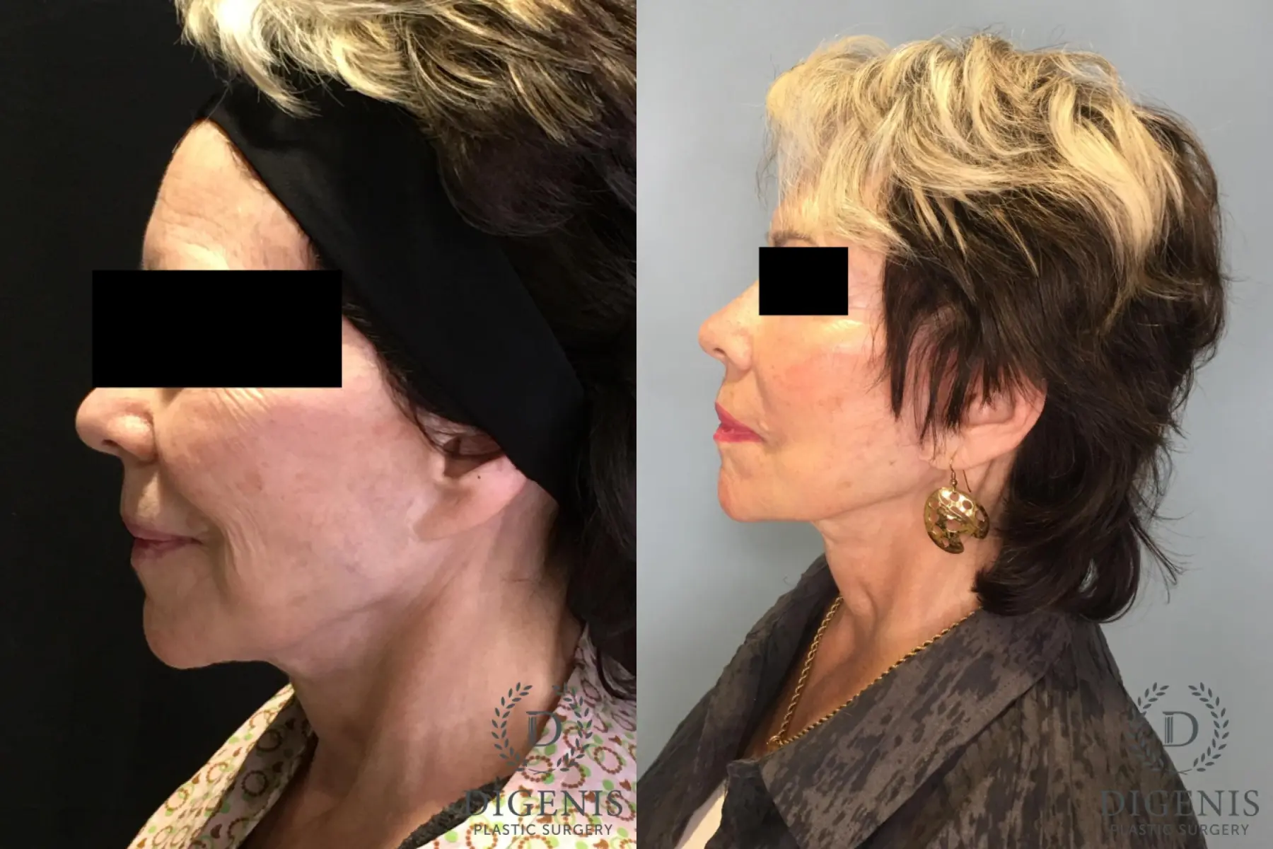 Facelift: Patient 29 - Before and After 5