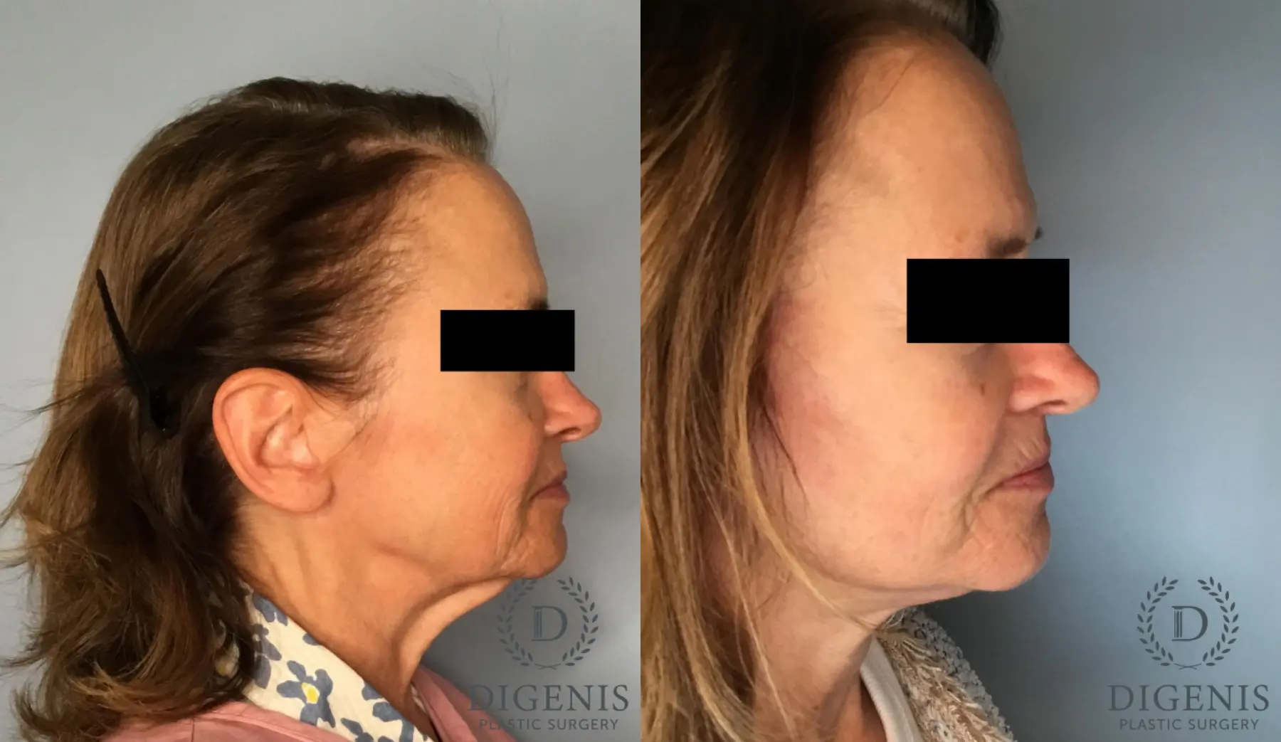 Facelift: Patient 16 - Before and After 3