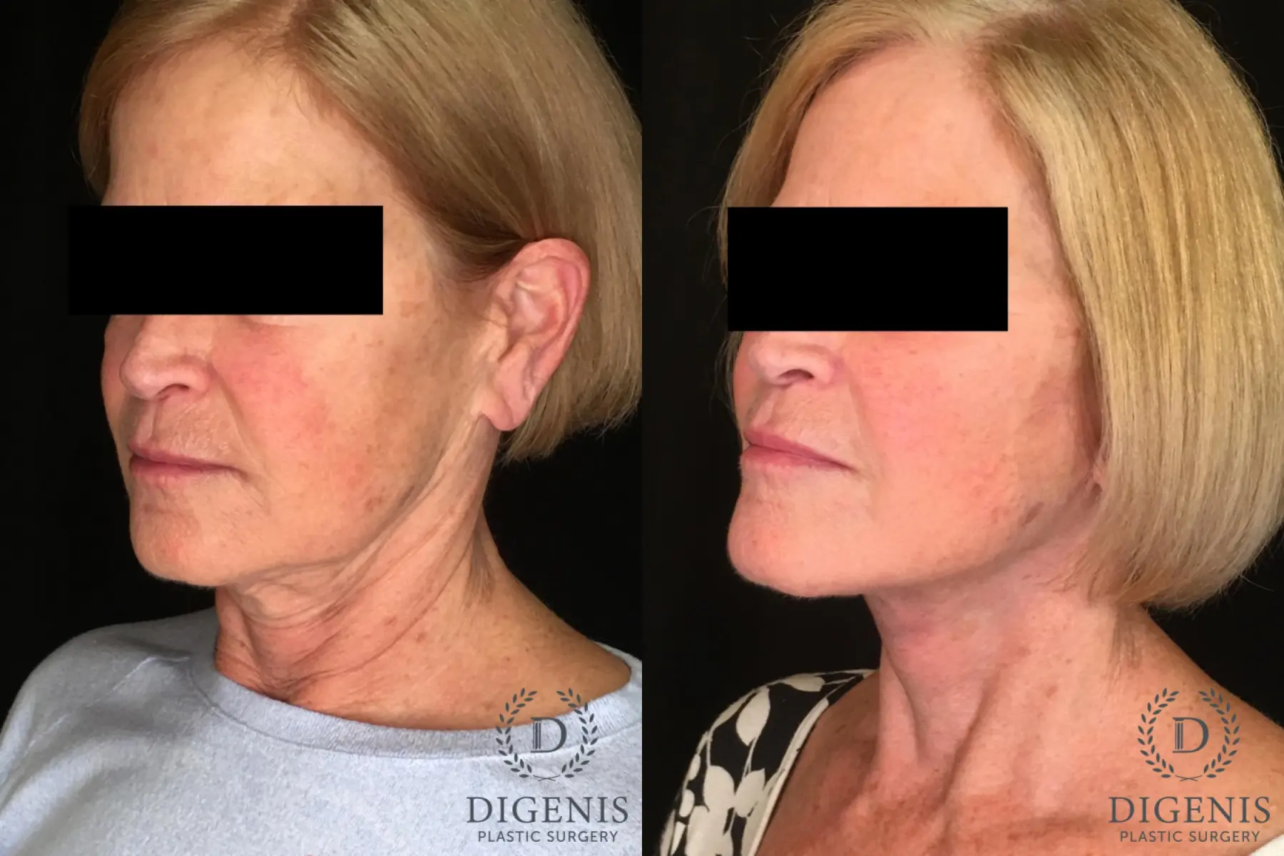 Facelift: Patient 1 - Before and After 4
