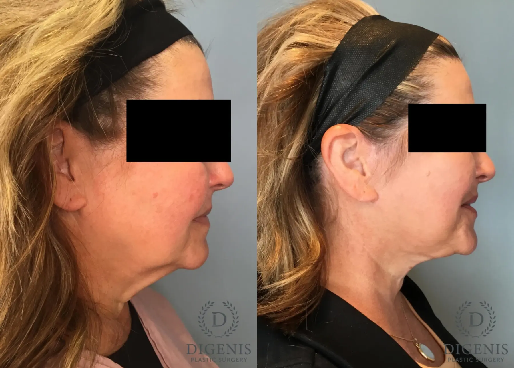 Facelift: Patient 61 - Before and After 5