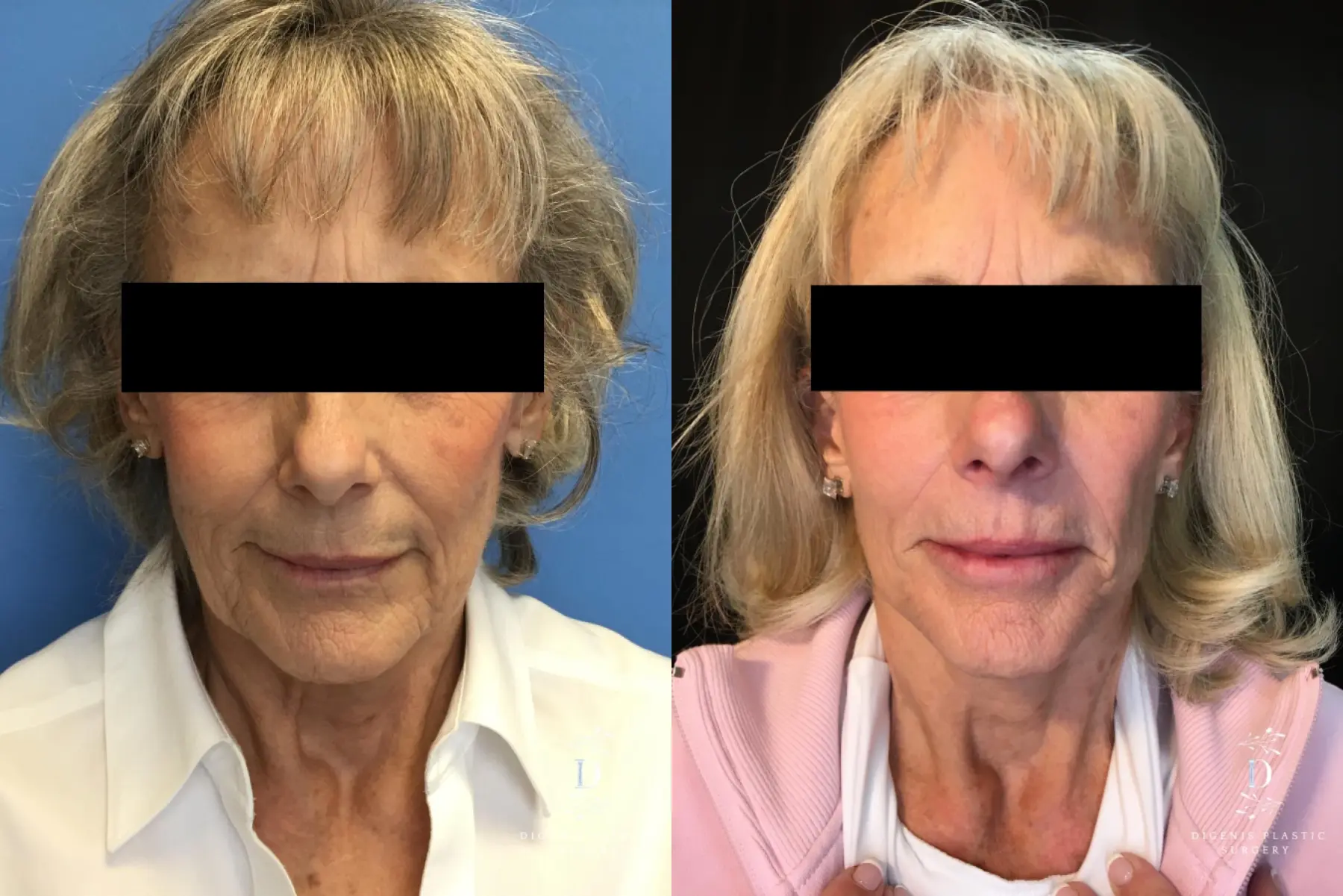 Facelift: Patient 19 - Before and After  