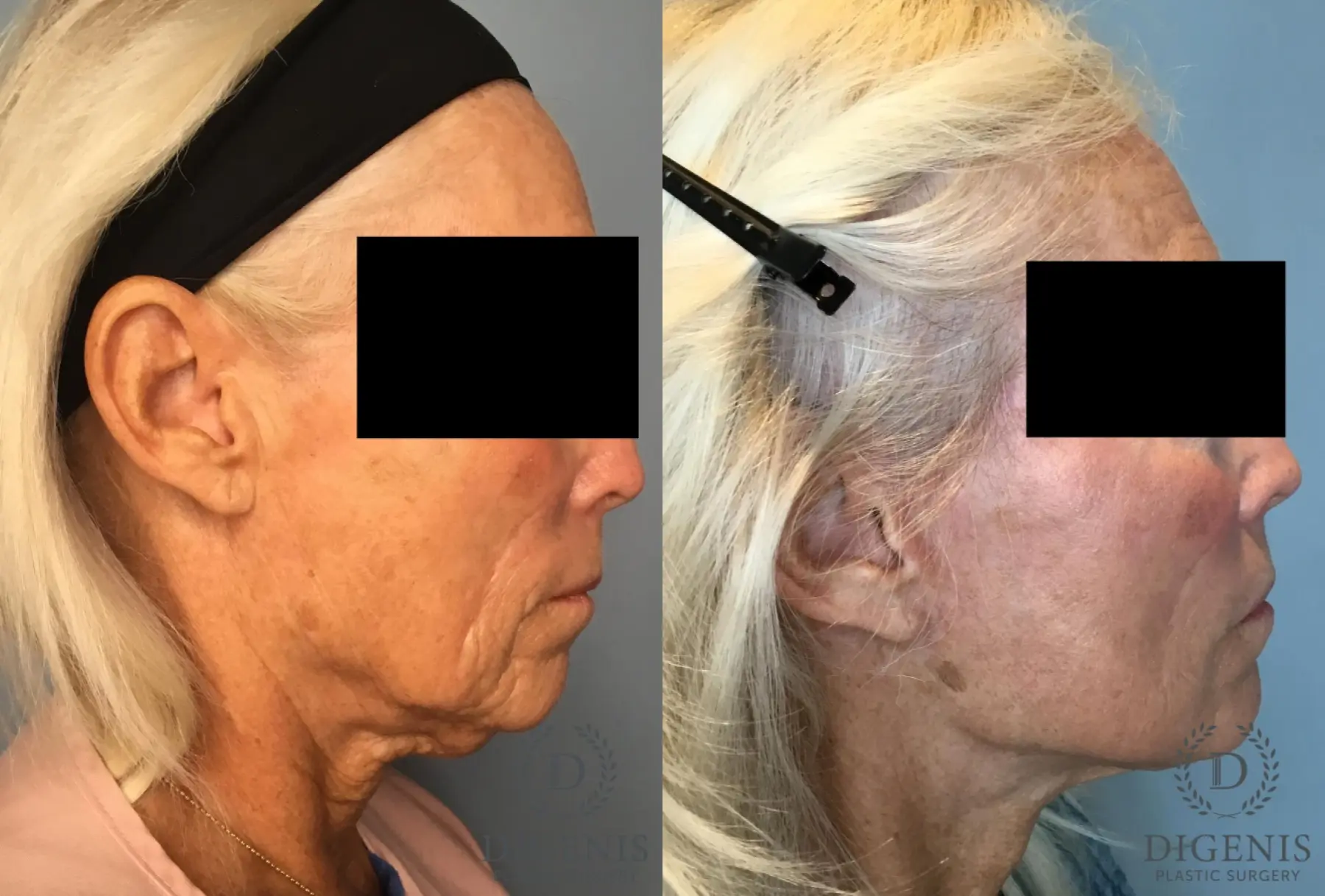 Facelift: Patient 63 - Before and After 5