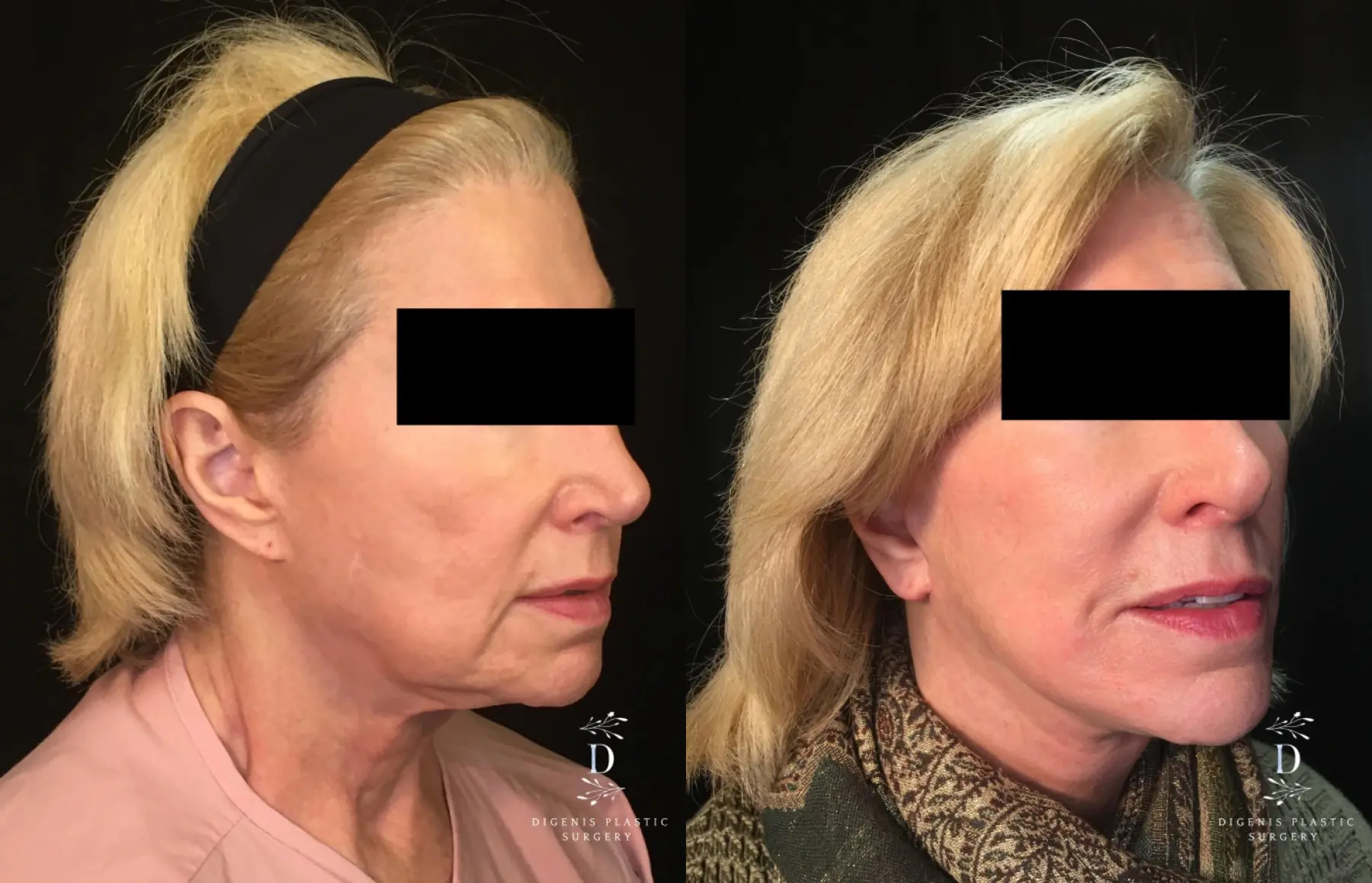 Facelift: Patient 21 - Before and After 2