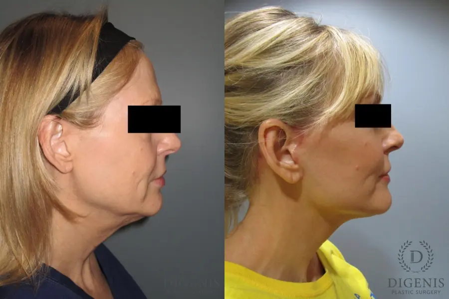 Facelift: Patient 5 - Before and After 3