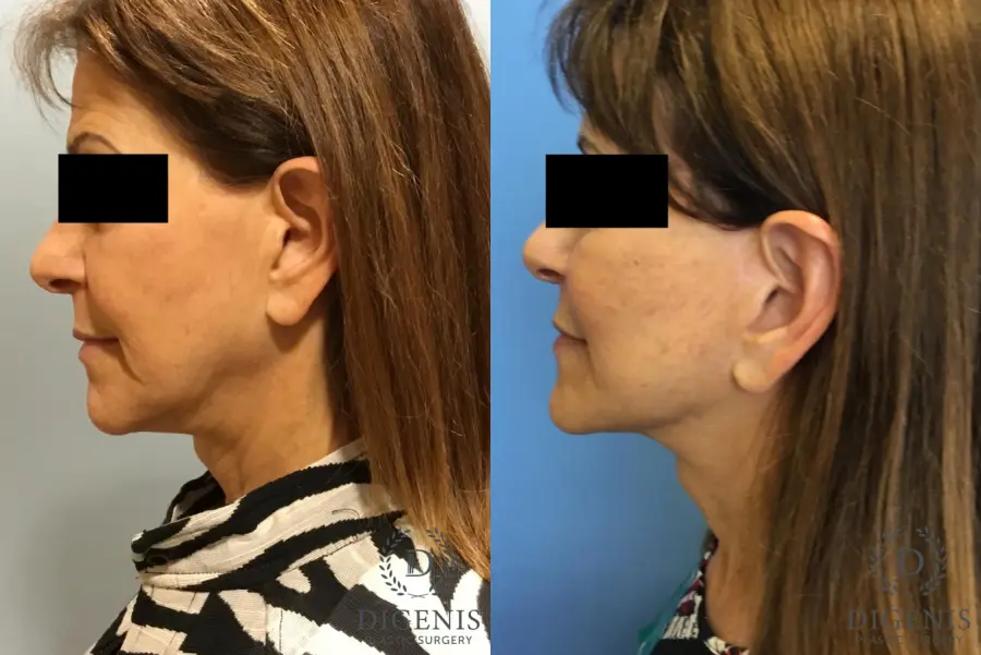 Facelift: Patient 6 - Before and After 5