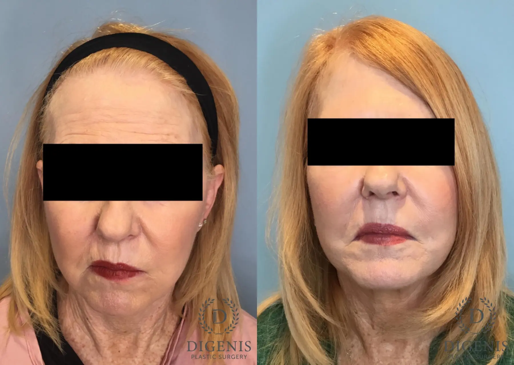 Facelift: Patient 67 - Before and After 1