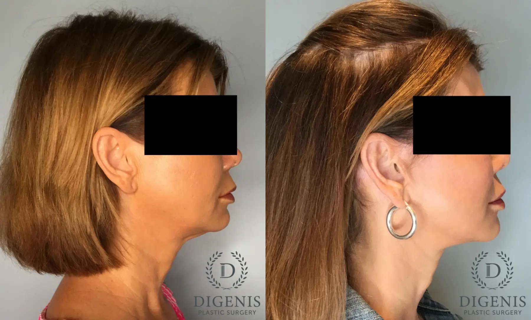 Facelift: Patient 72 - Before and After 3