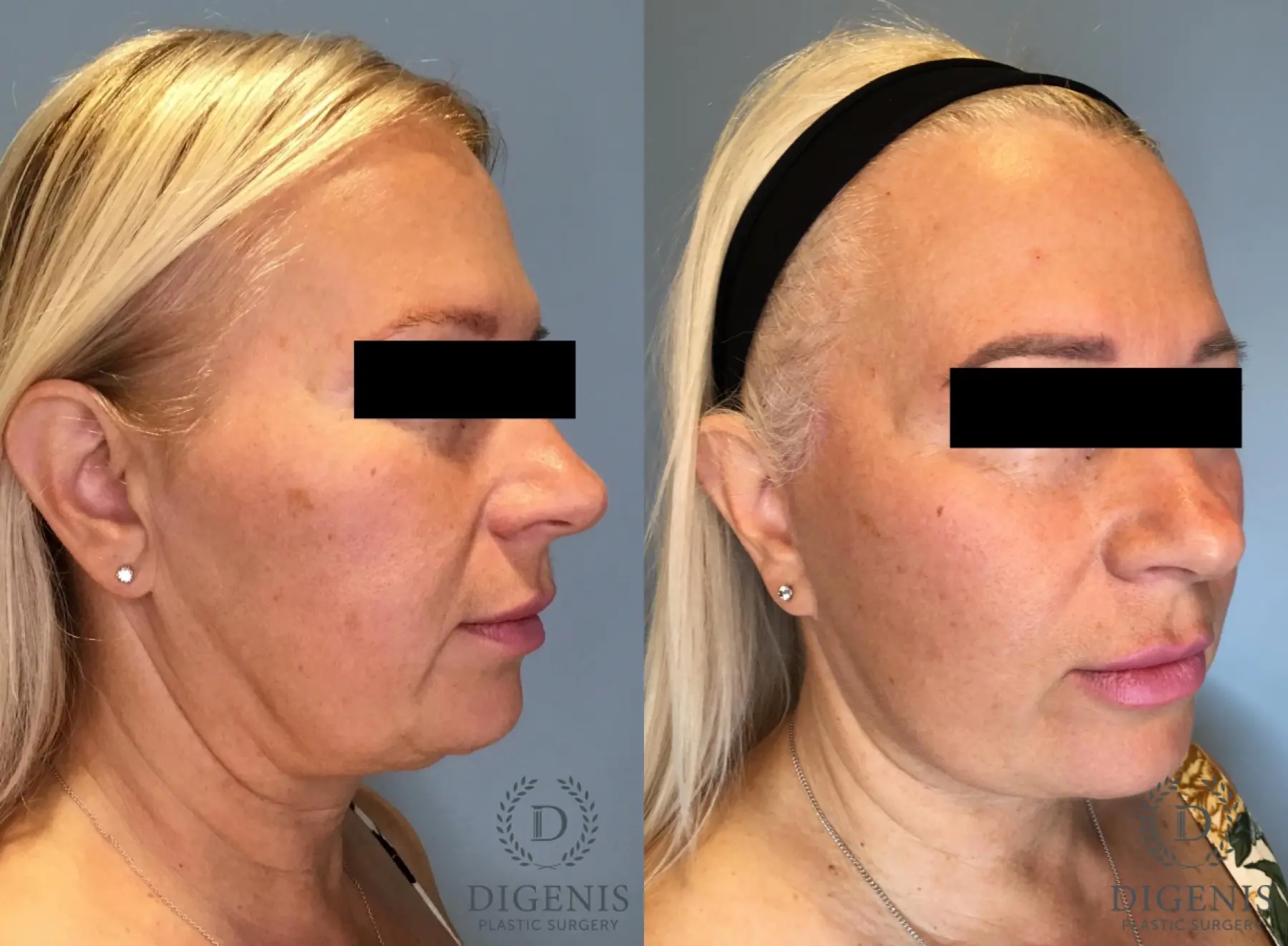 Facelift: Patient 65 - Before and After 2