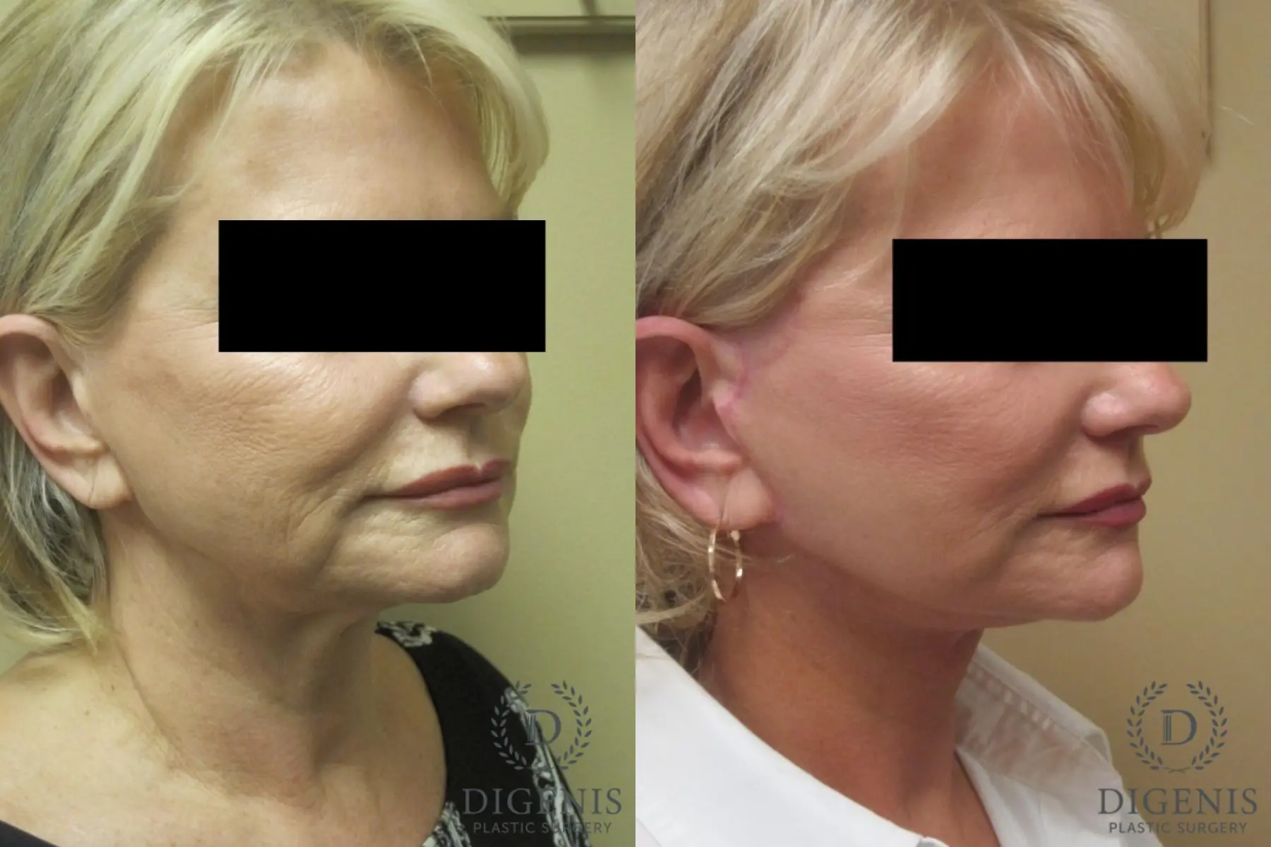 Facelift: Patient 15 - Before and After 2
