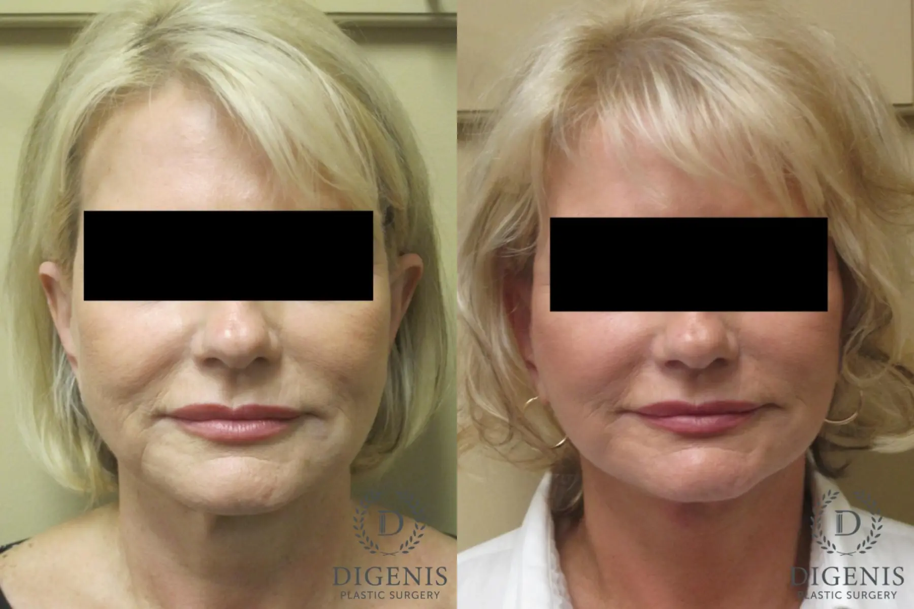 Facelift: Patient 15 - Before and After  