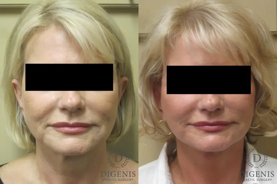 Facelift: Patient 14 - Before and After 1