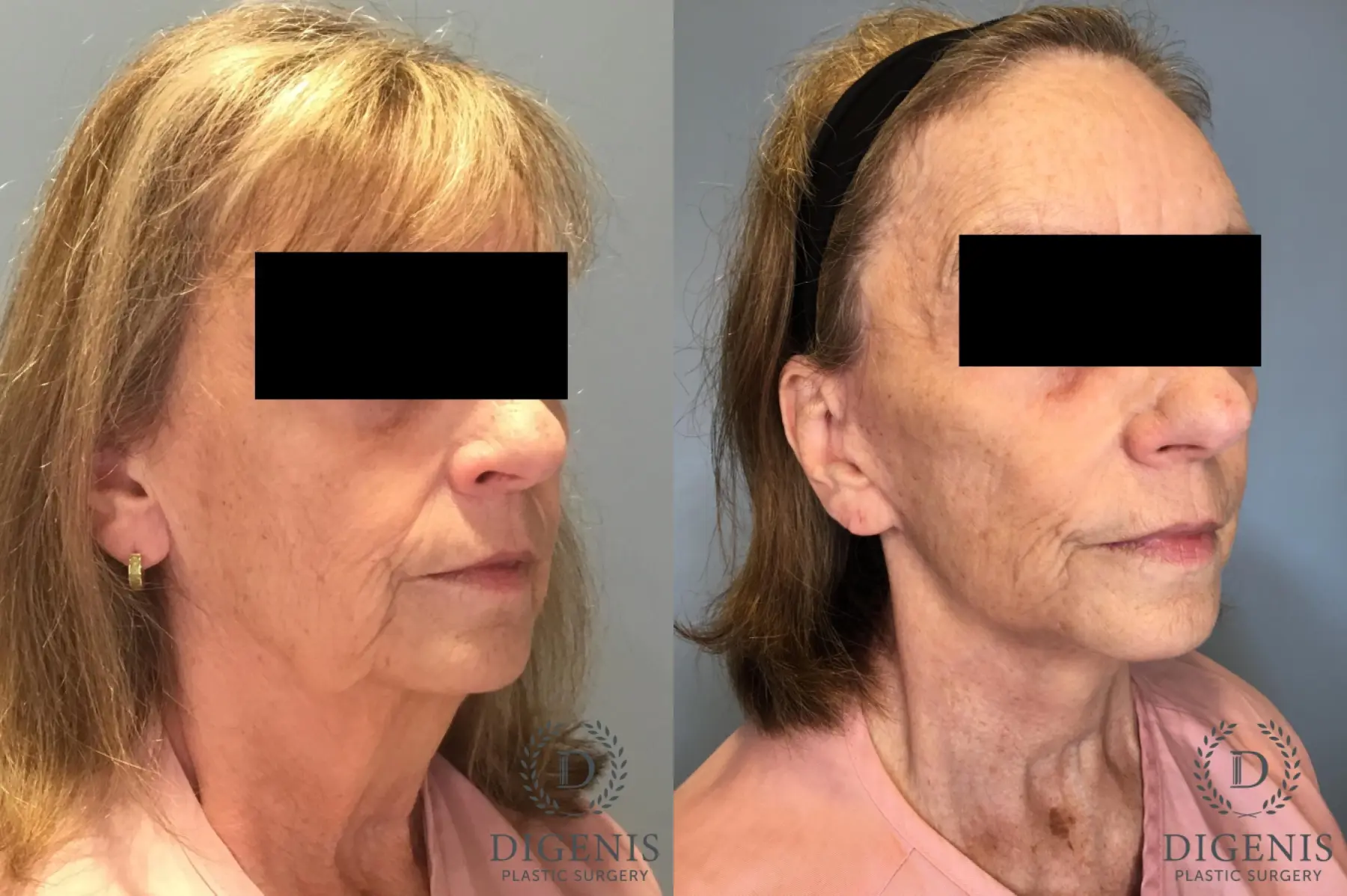 Facelift: Patient 20 - Before and After 4