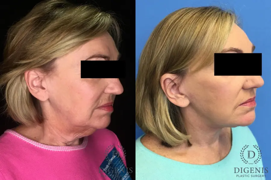 Facelift: Patient 2 - Before and After 4