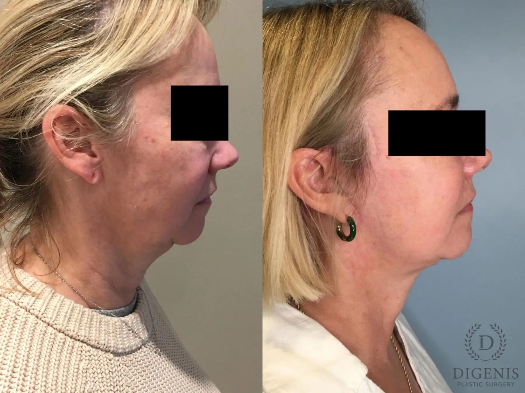 Facelift: Patient 30 - Before and After 4