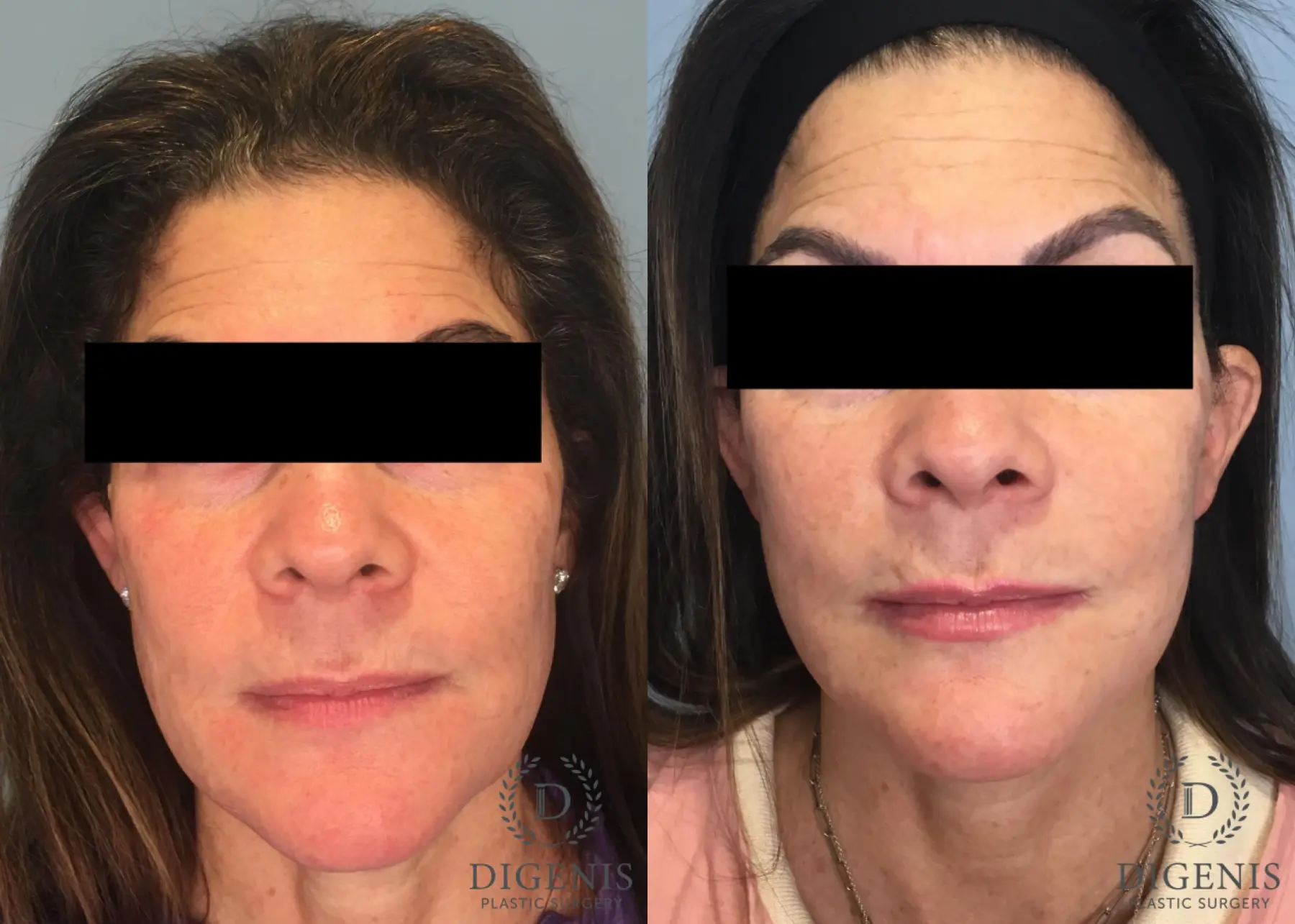 Facelift: Patient 3 - Before and After  