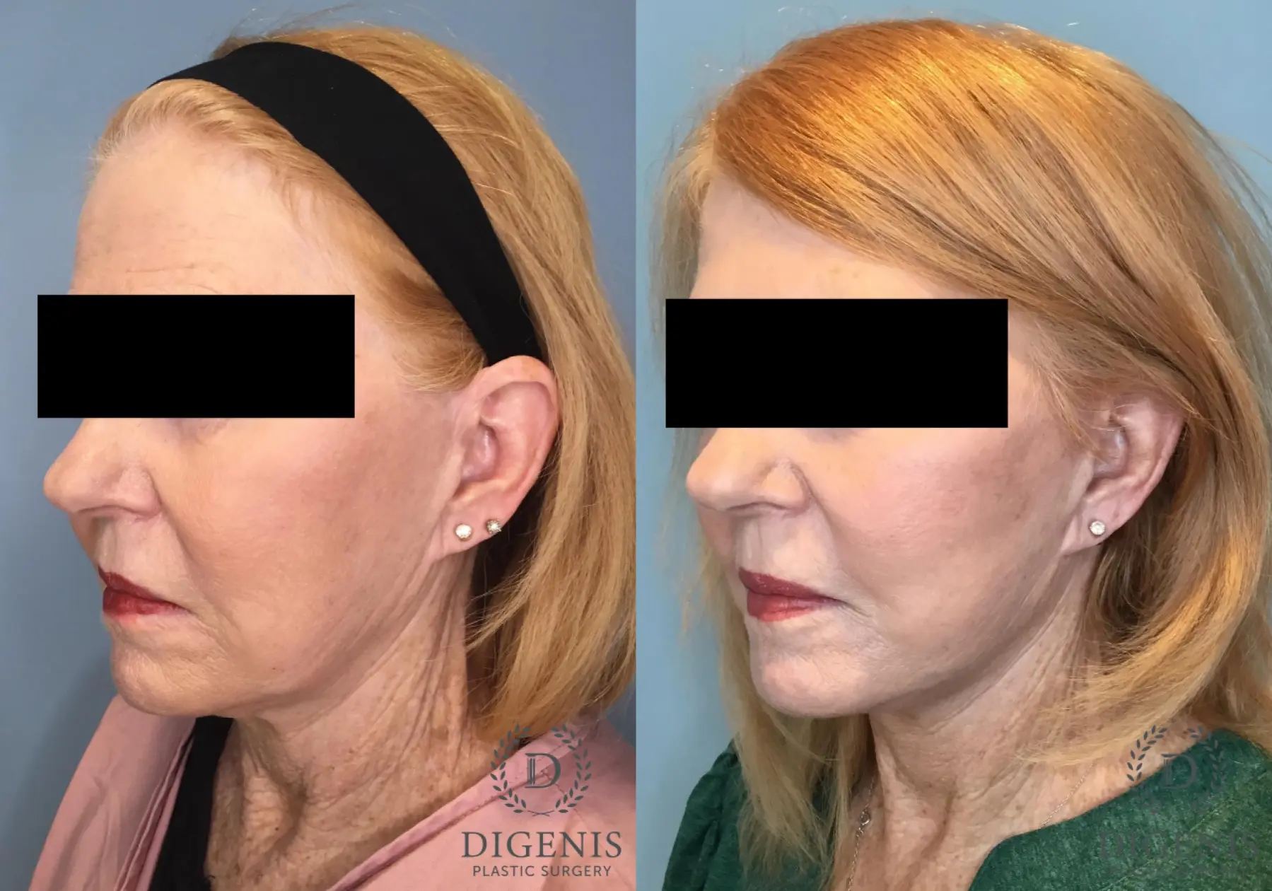 Facelift: Patient 67 - Before and After 2