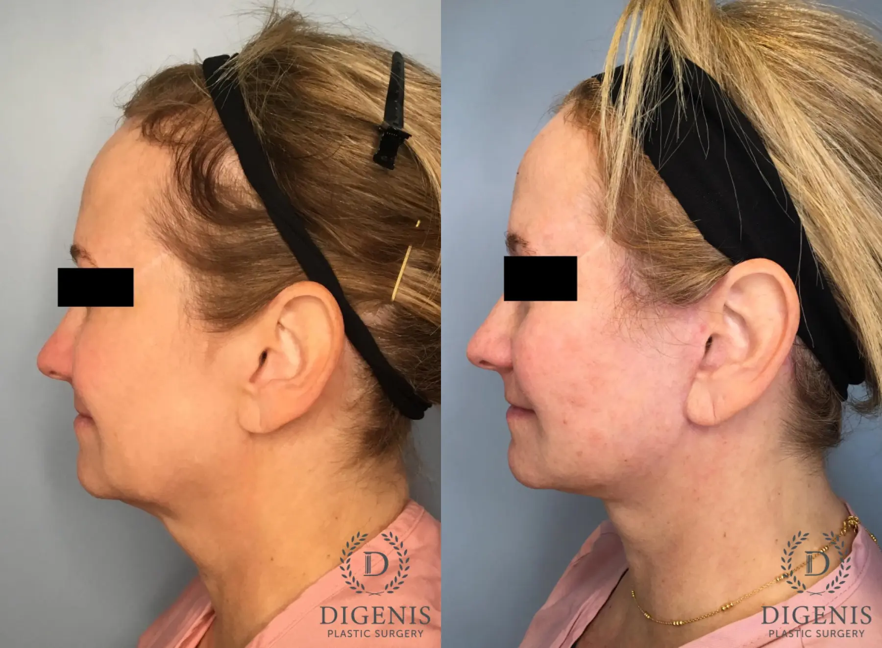 Facelift: Patient 13 - Before and After 5