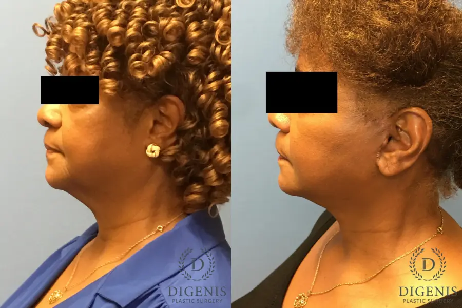 Facelift: Patient 8 - Before and After 4