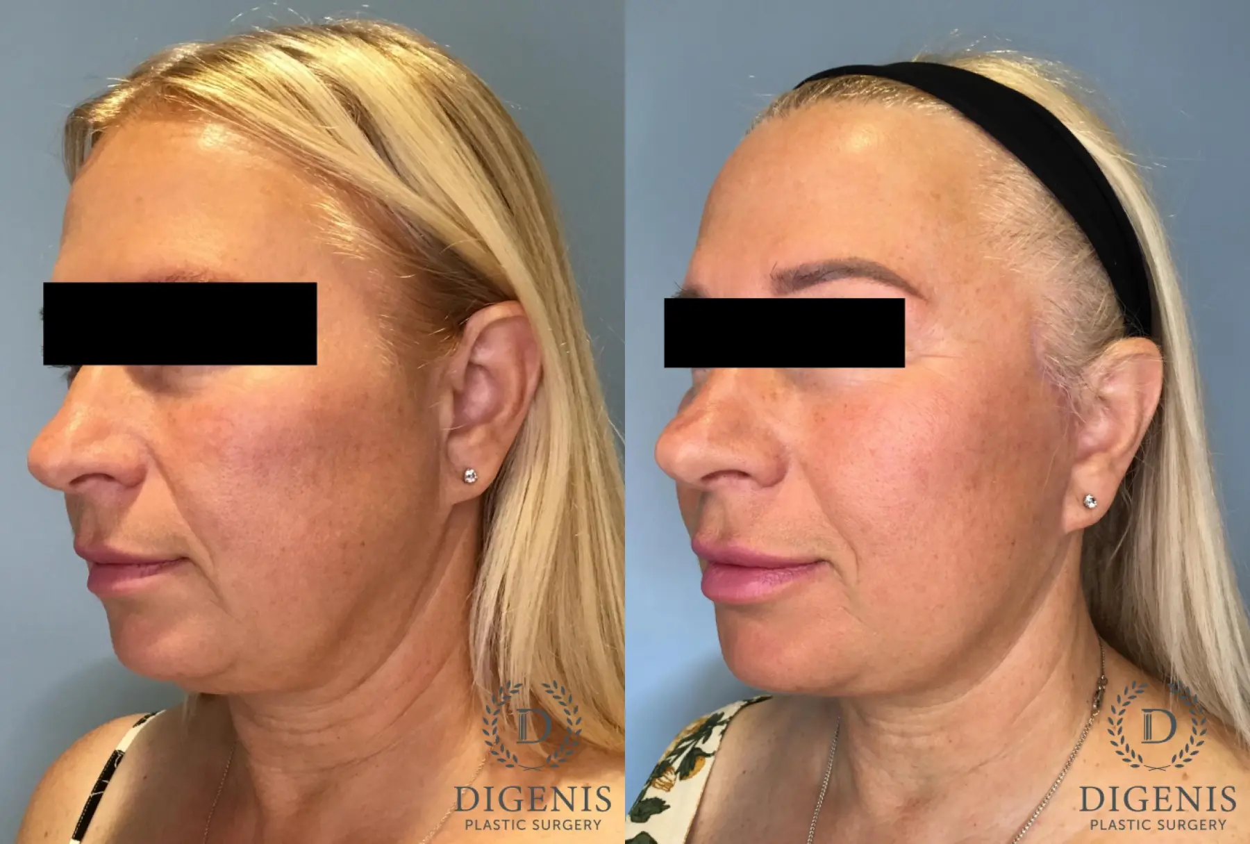 Facelift: Patient 65 - Before and After 4