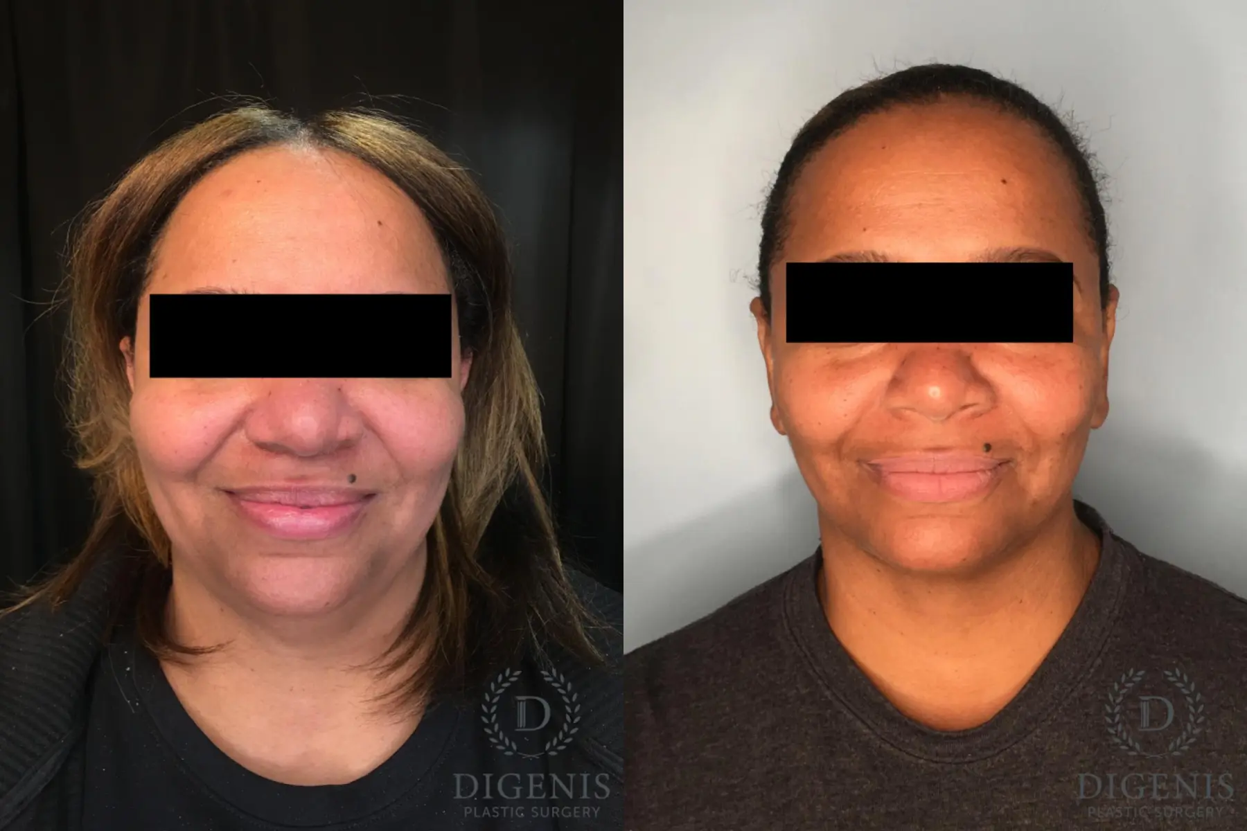 Facelift: Patient 63 - Before and After 1