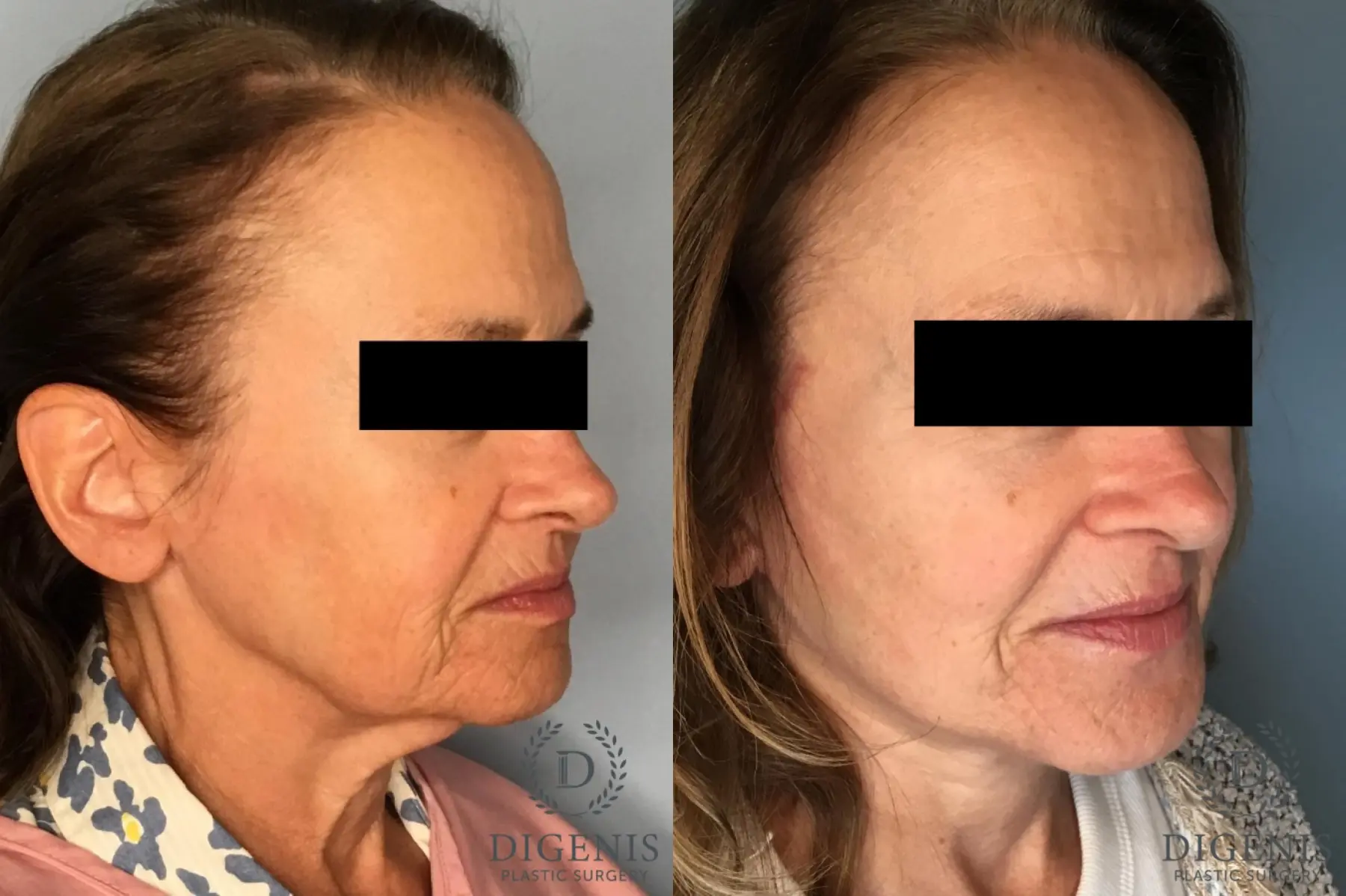 Facelift: Patient 16 - Before and After 2