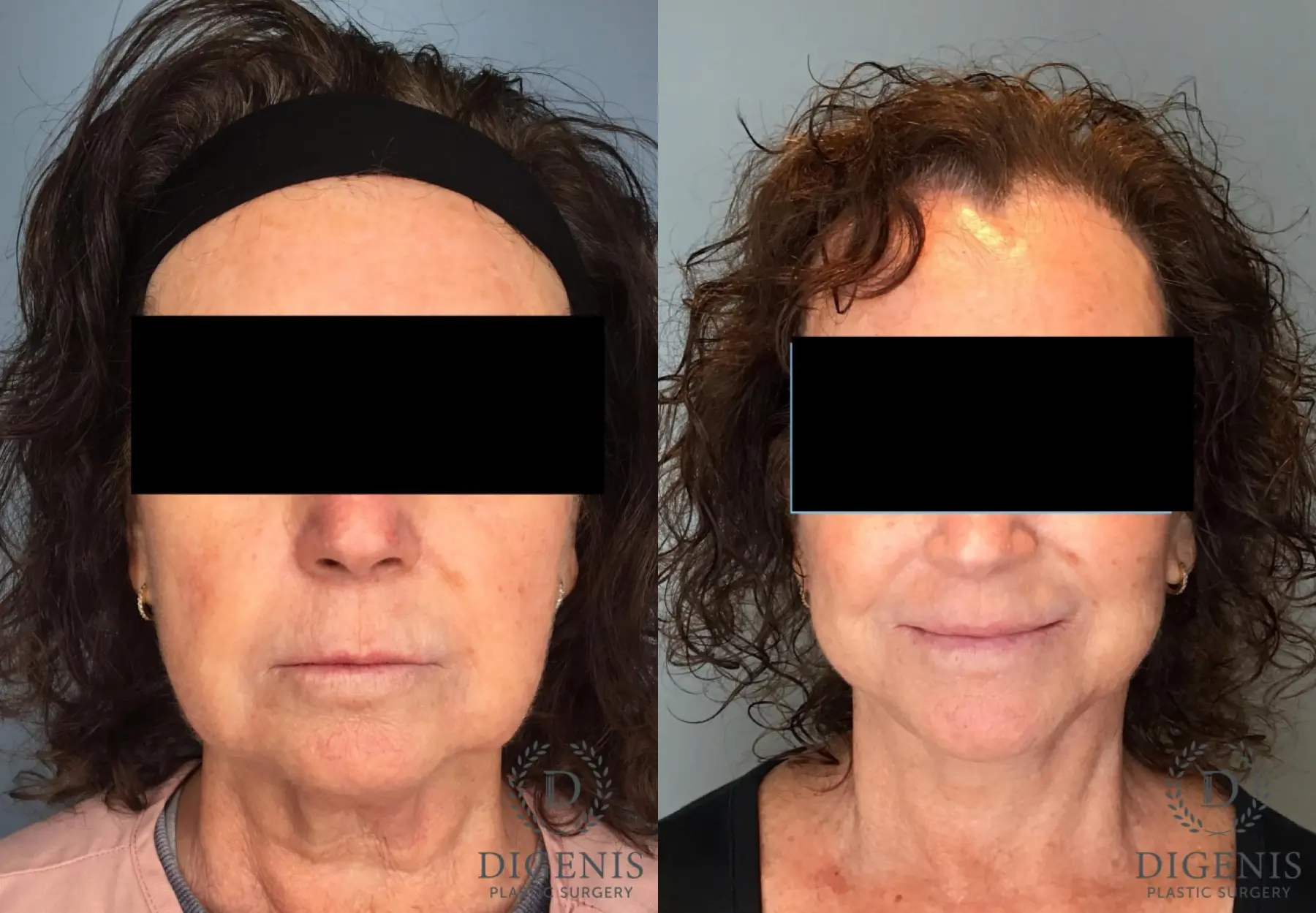 Facelift: Patient 71 - Before and After  