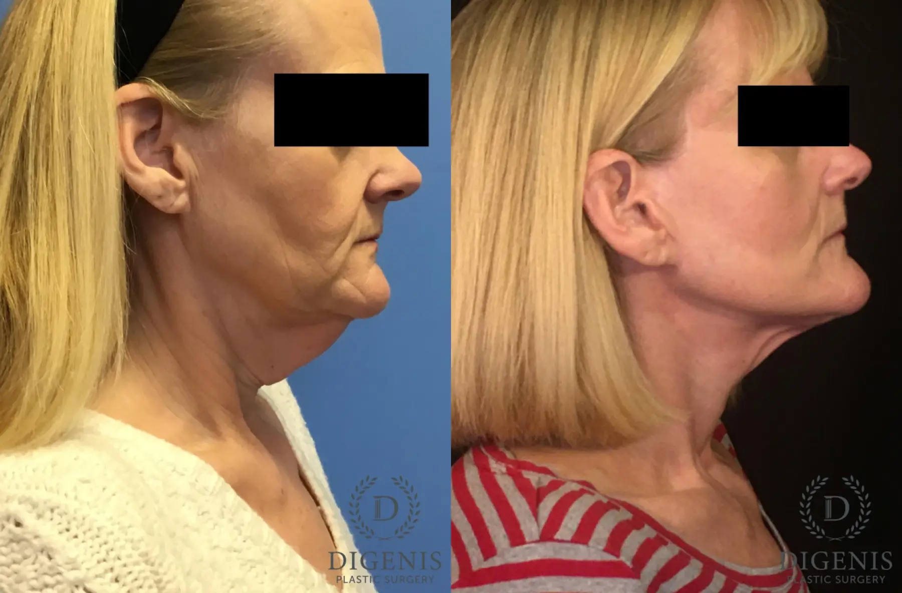 Facelift: Patient 4 - Before and After 3