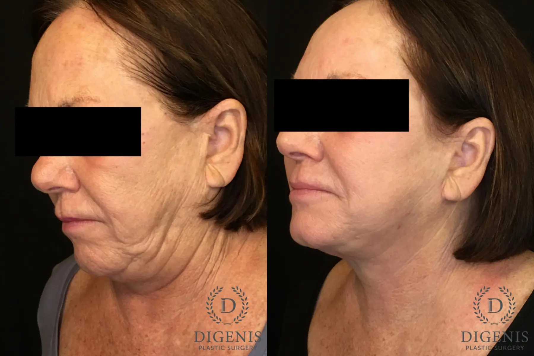 Facelift: Patient 13 - Before and After 4