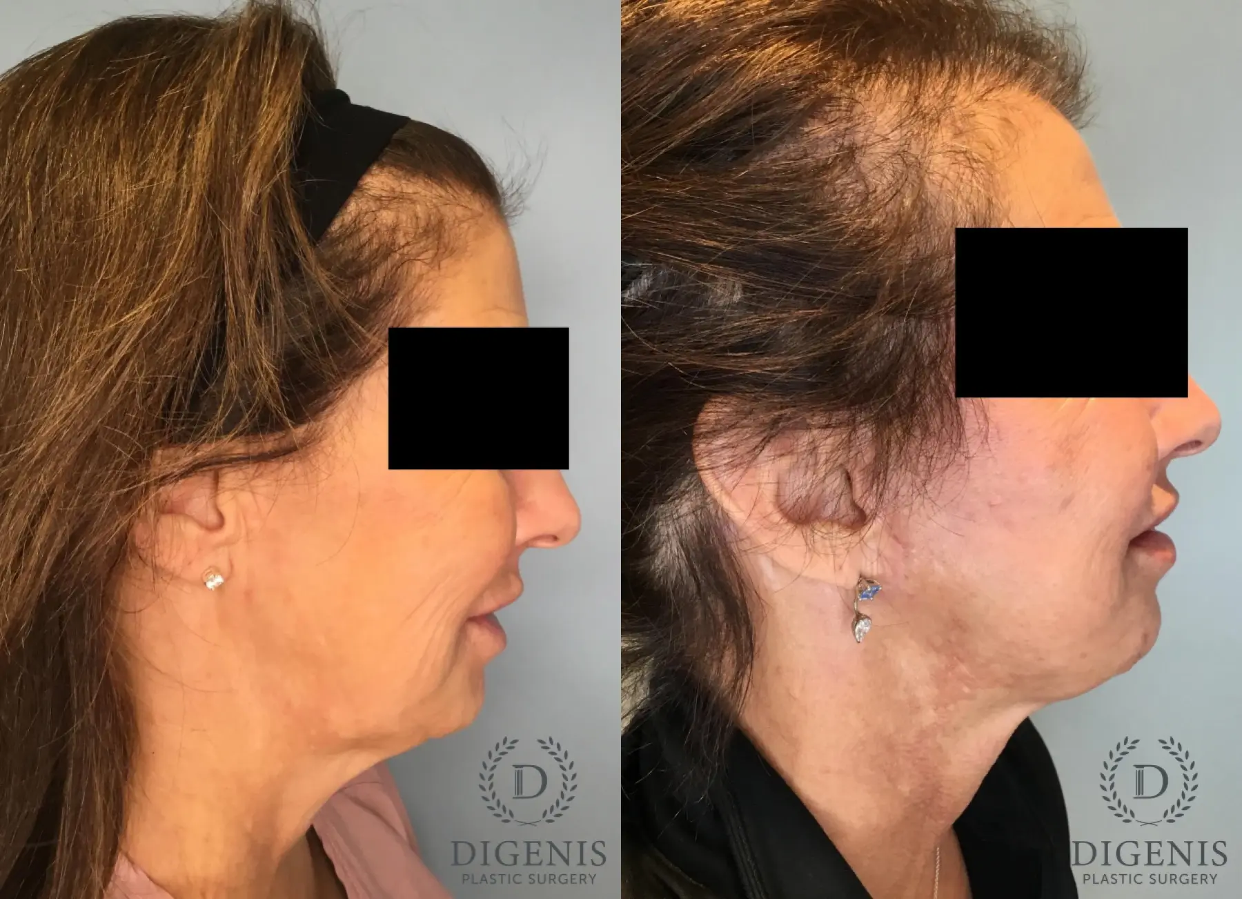 Facelift: Patient 62 - Before and After 3