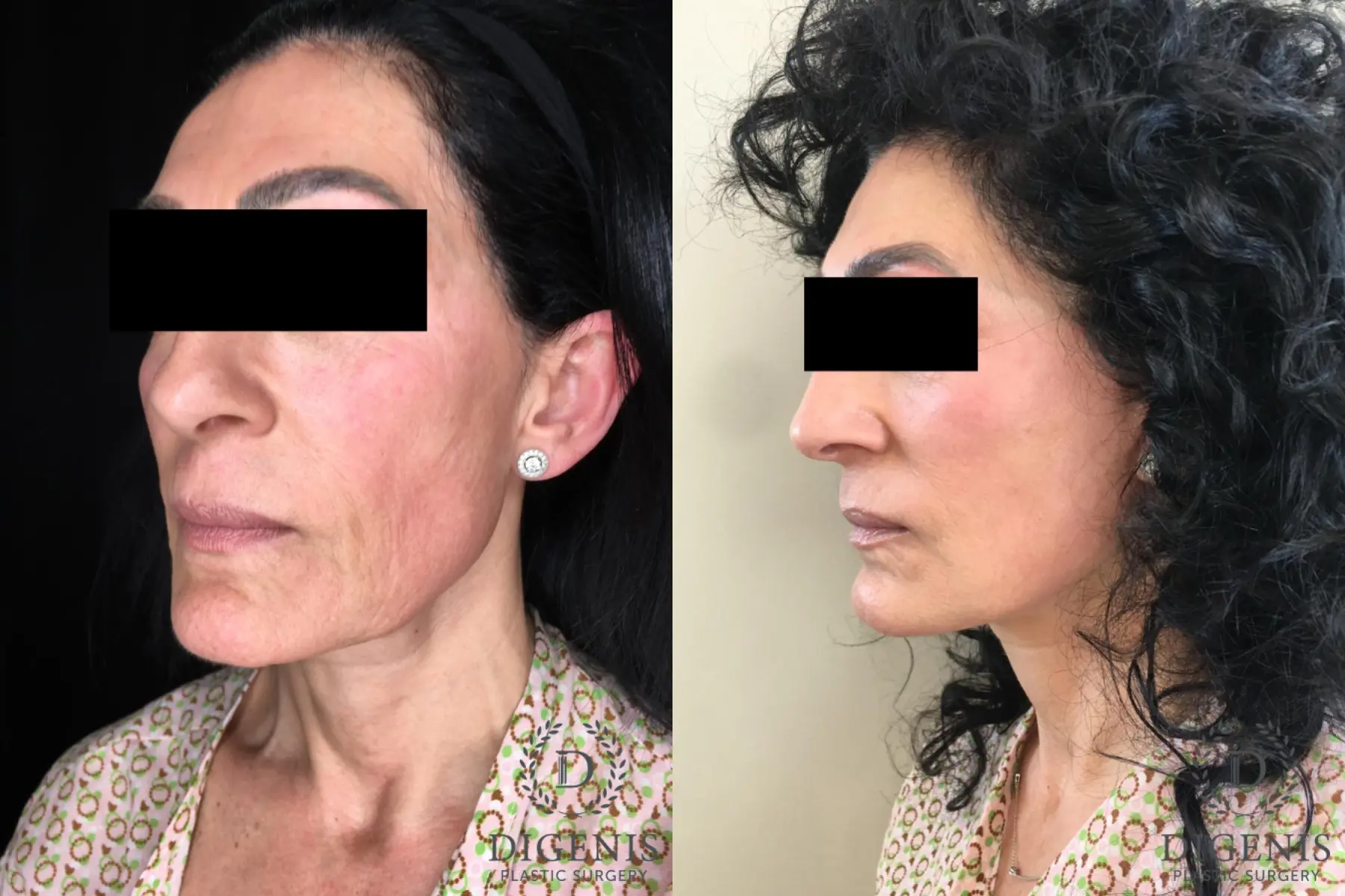 Facelift: Patient 28 - Before and After 4