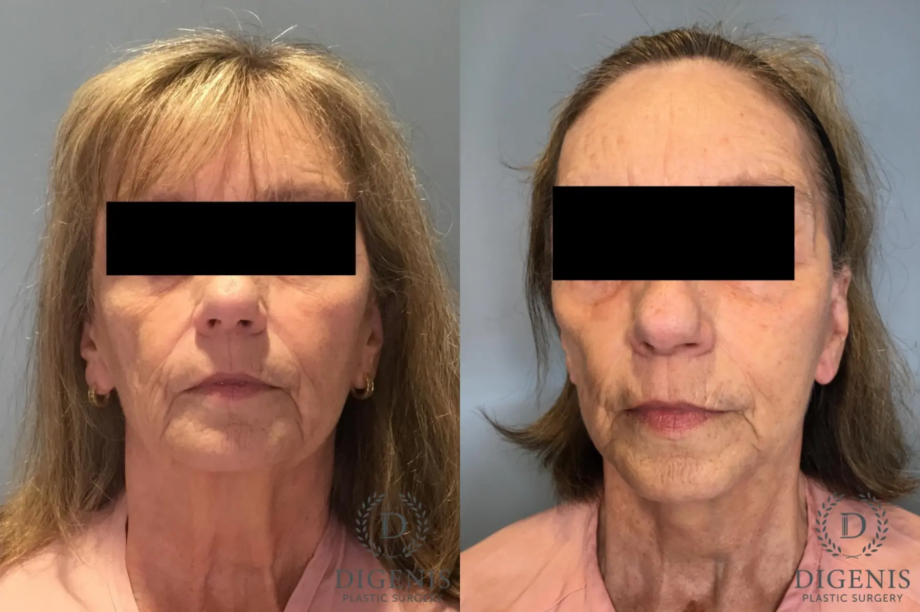 Facelift: Patient 20 - Before and After  