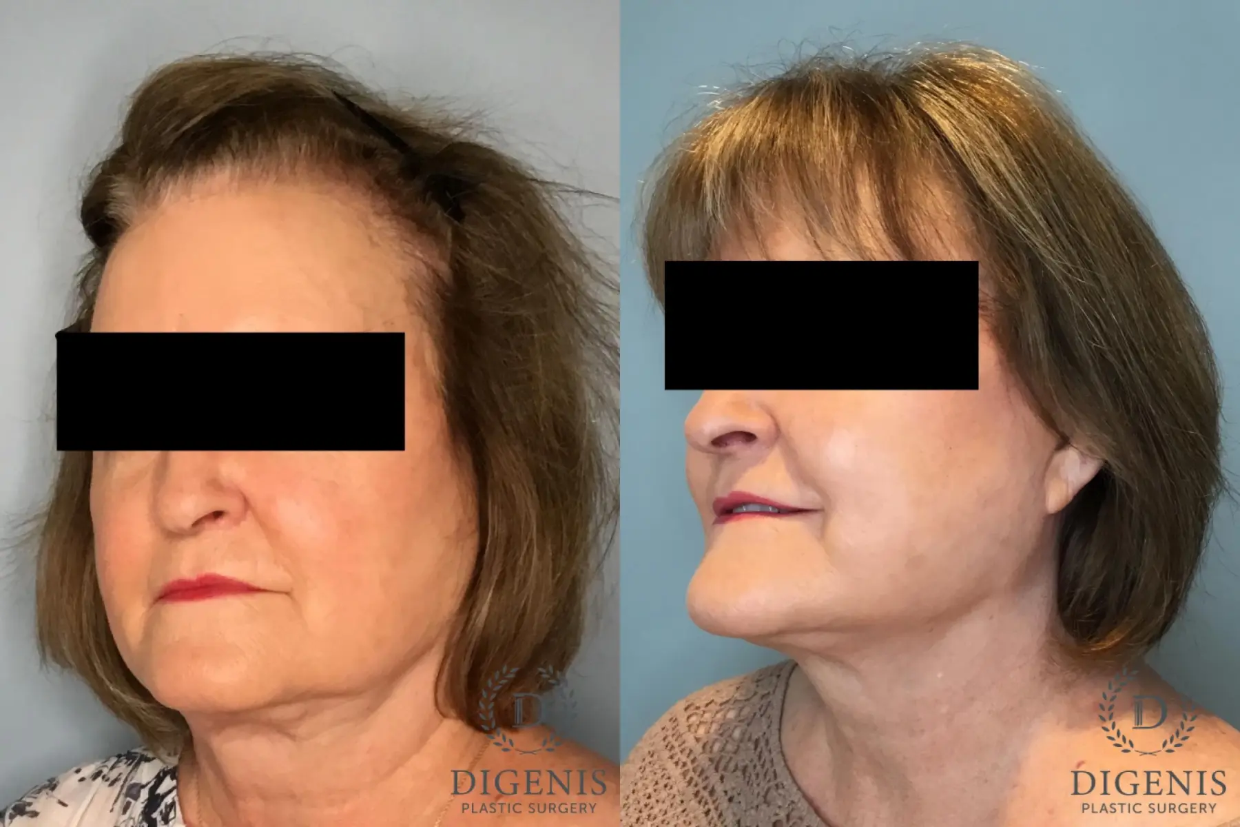 Facelift: Patient 62 - Before and After 5