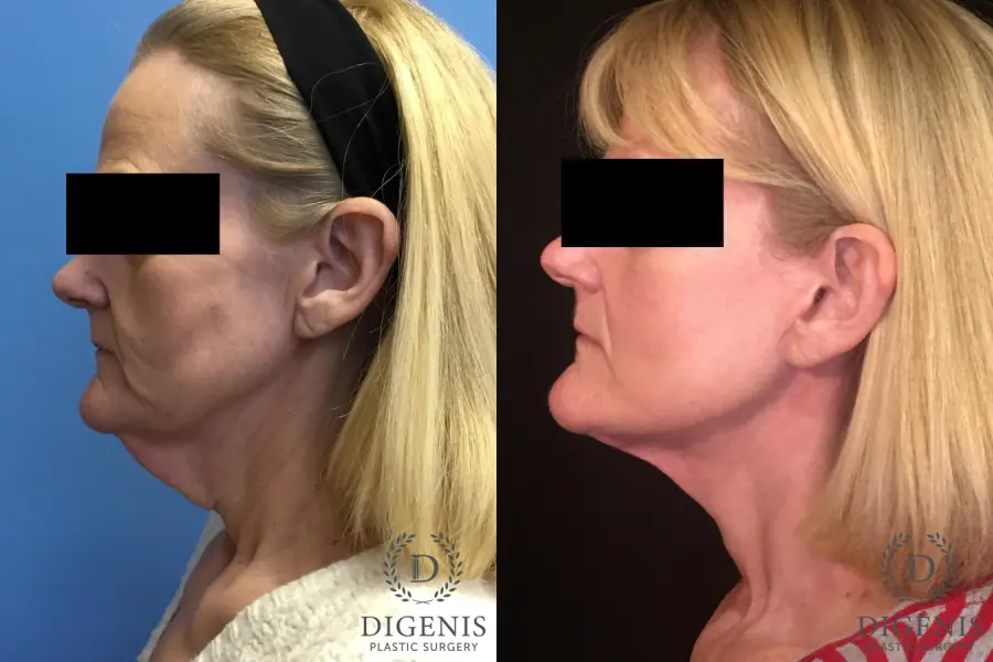 Facelift: Patient 3 - Before and After 5