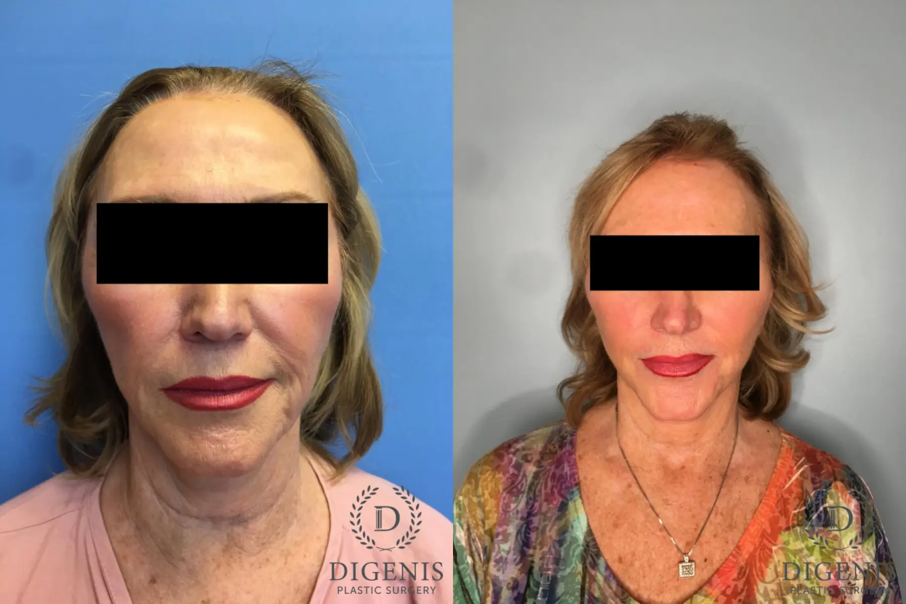 Facelift: Patient 25 - Before and After  