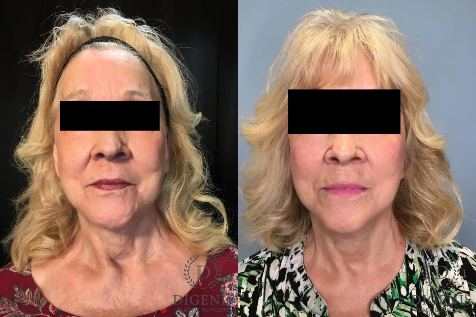 Facelift: Patient 24 - Before and After  