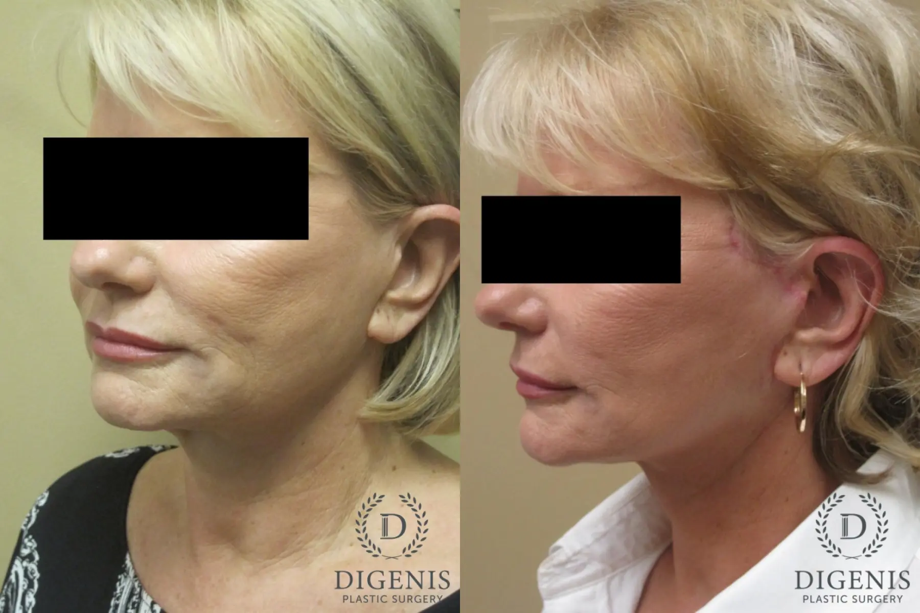 Facelift: Patient 15 - Before and After 4