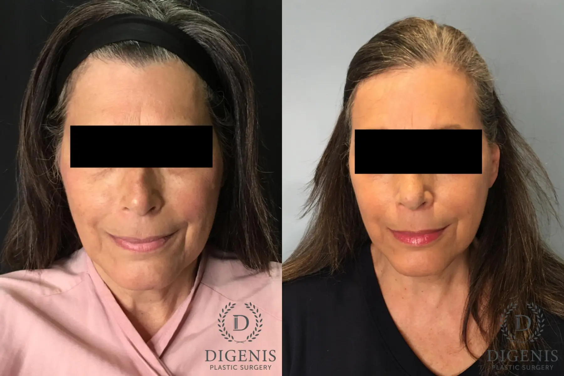 Facelift: Patient 26 - Before and After  