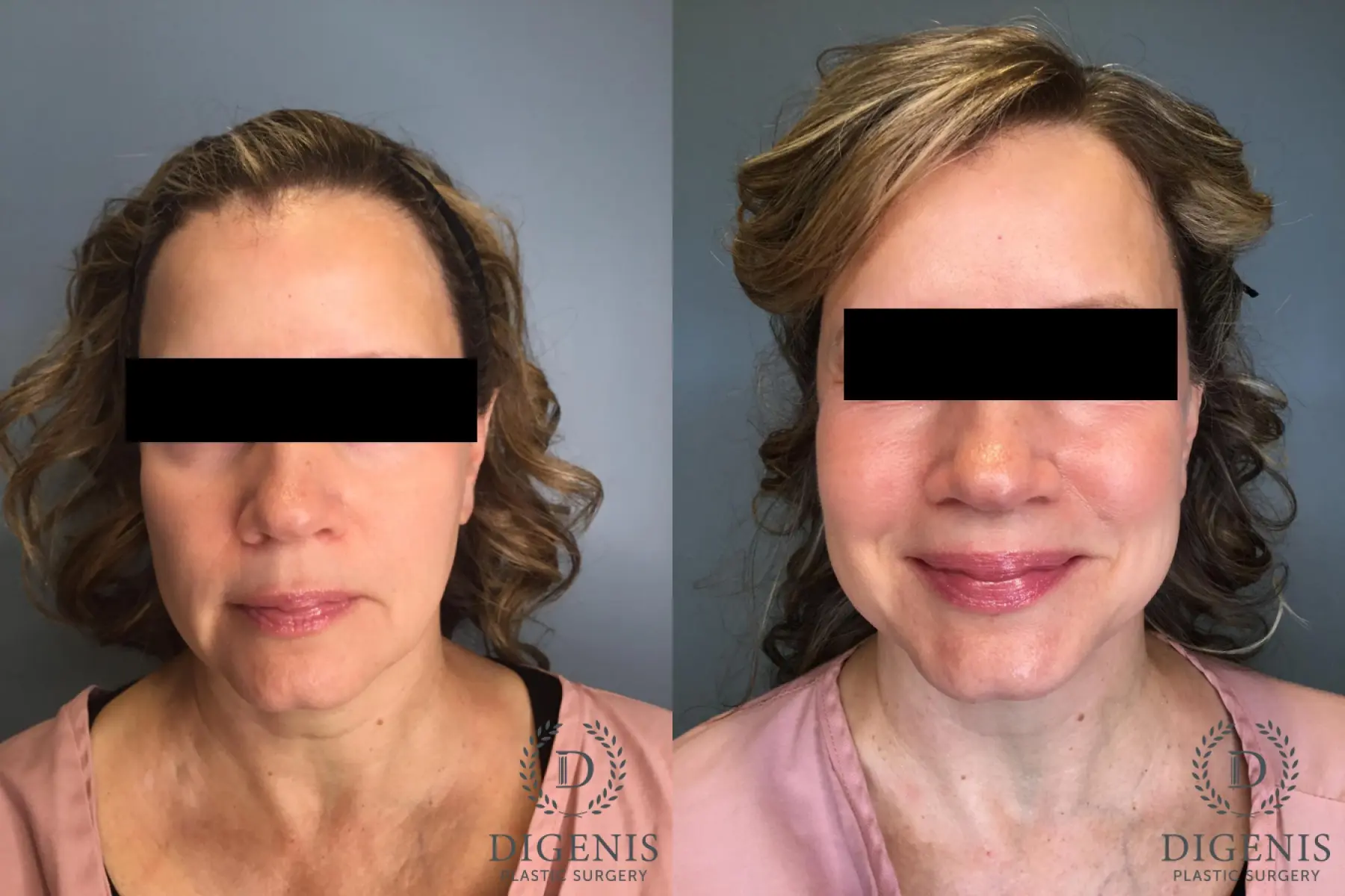Facelift: Patient 60 - Before and After  