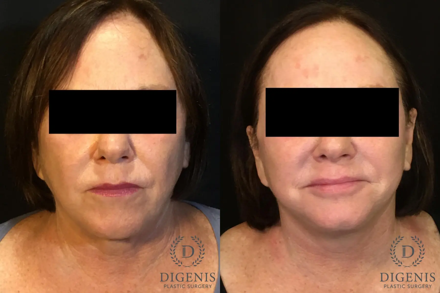 Facelift: Patient 14 - Before and After  